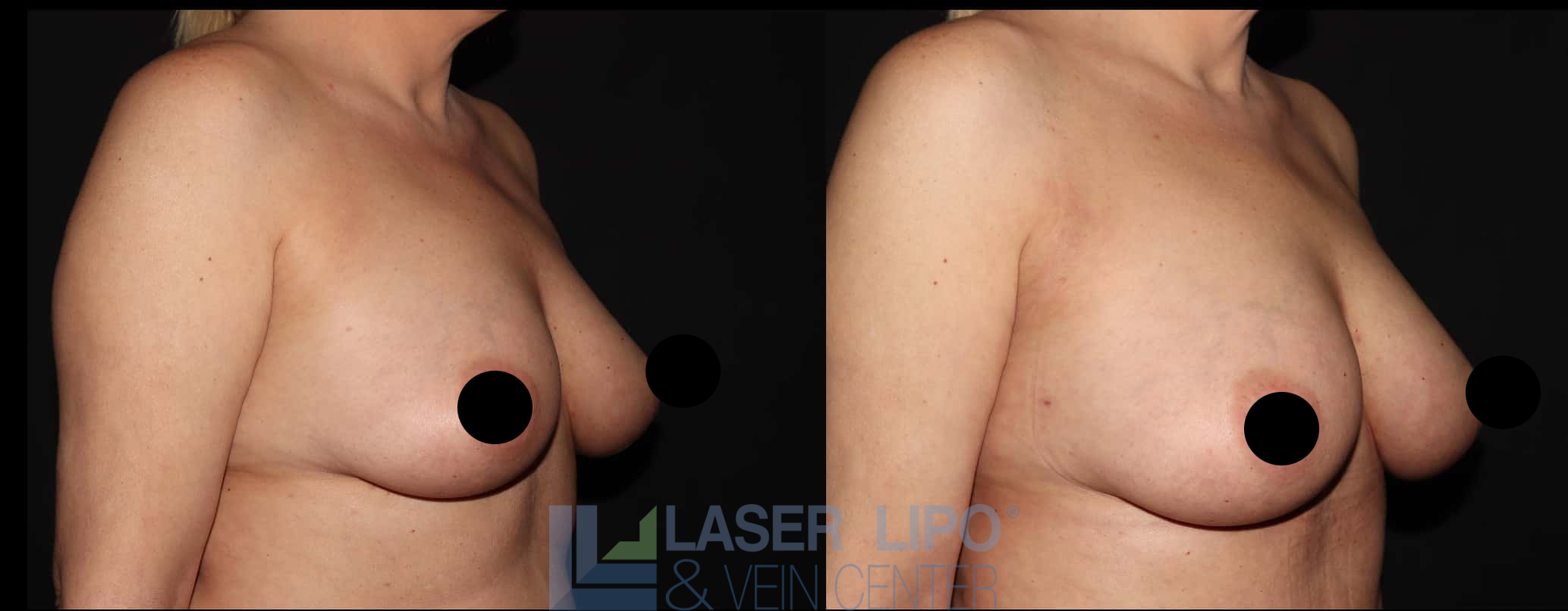 Before and After Image: Fat Transfer to Breast - right-front-oblique
