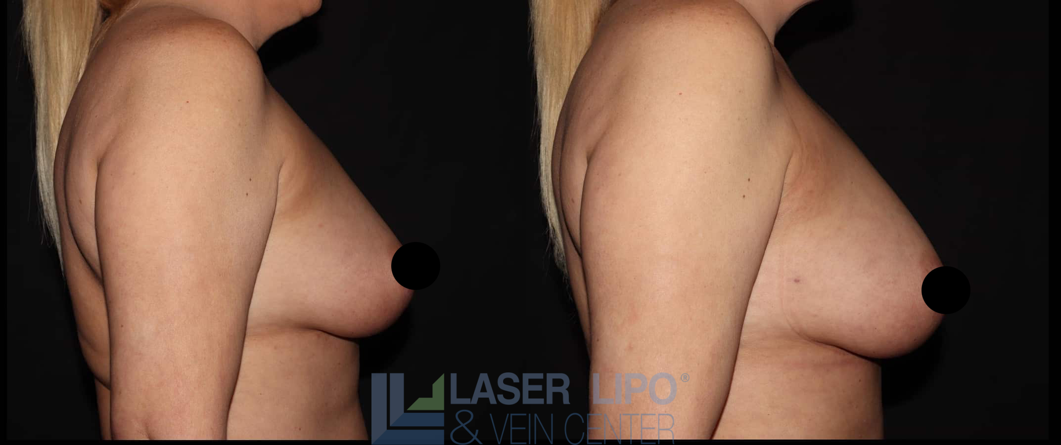 Before and After Image: Fat Transfer to Breast - right-side