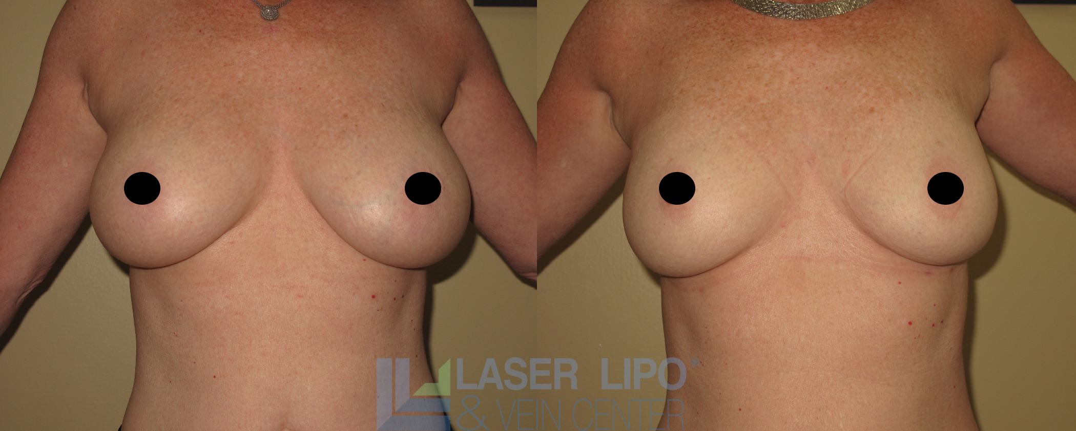 Before and After Image: Lipo/Renuvion to Breast - front