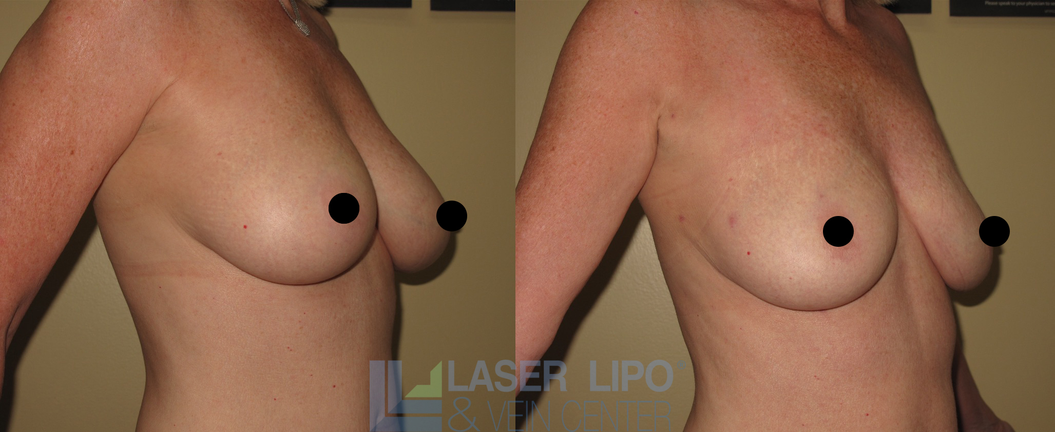 Before and After Image: Lipo/Renuvion to Breast - right-front-oblique