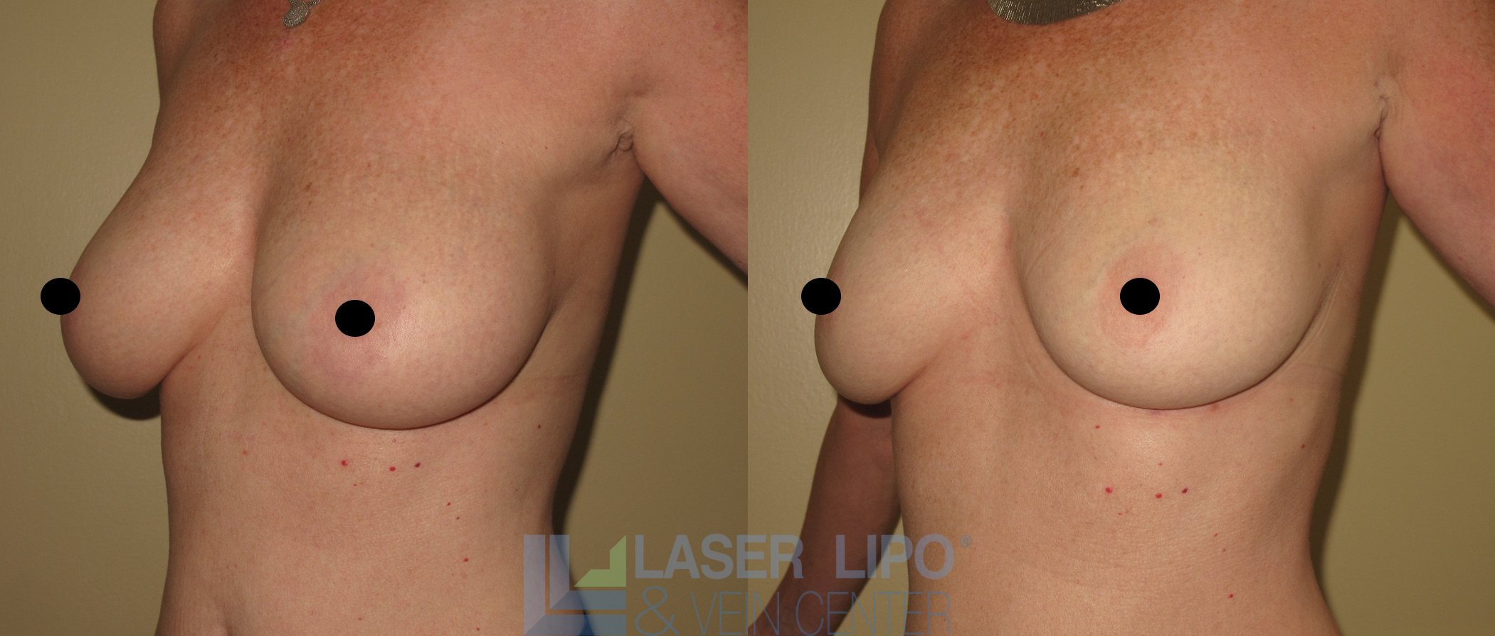 Before and After Image: Lipo/Renuvion to Breast - left-front-oblique