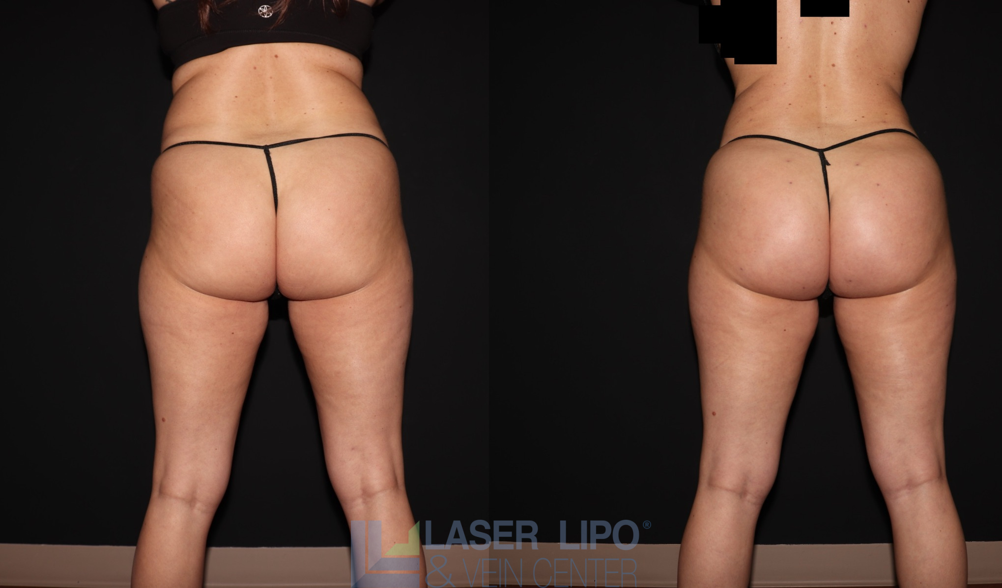 Before and After Image: BBL - front