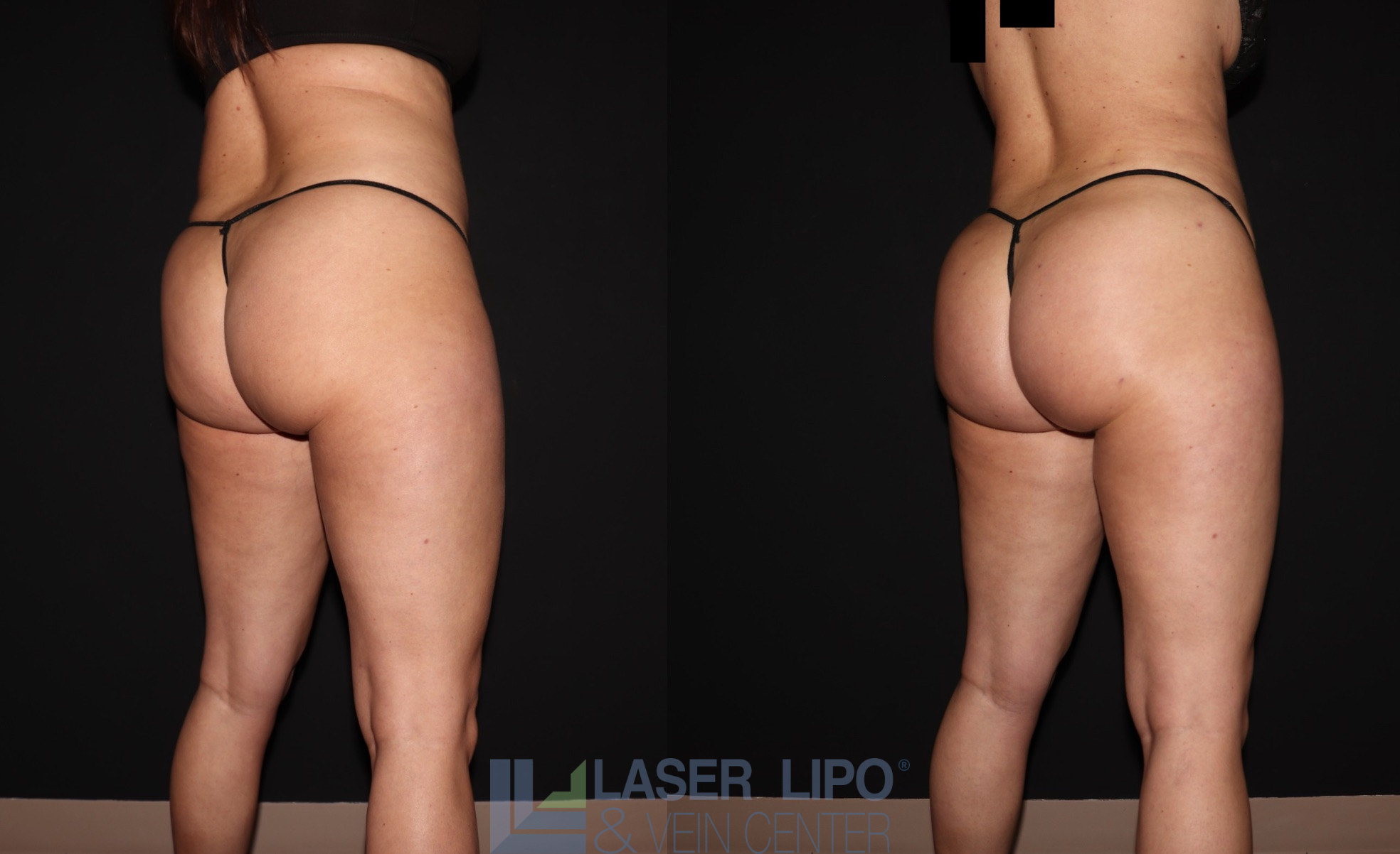 Before and After Image: BBL - right-back-oblique