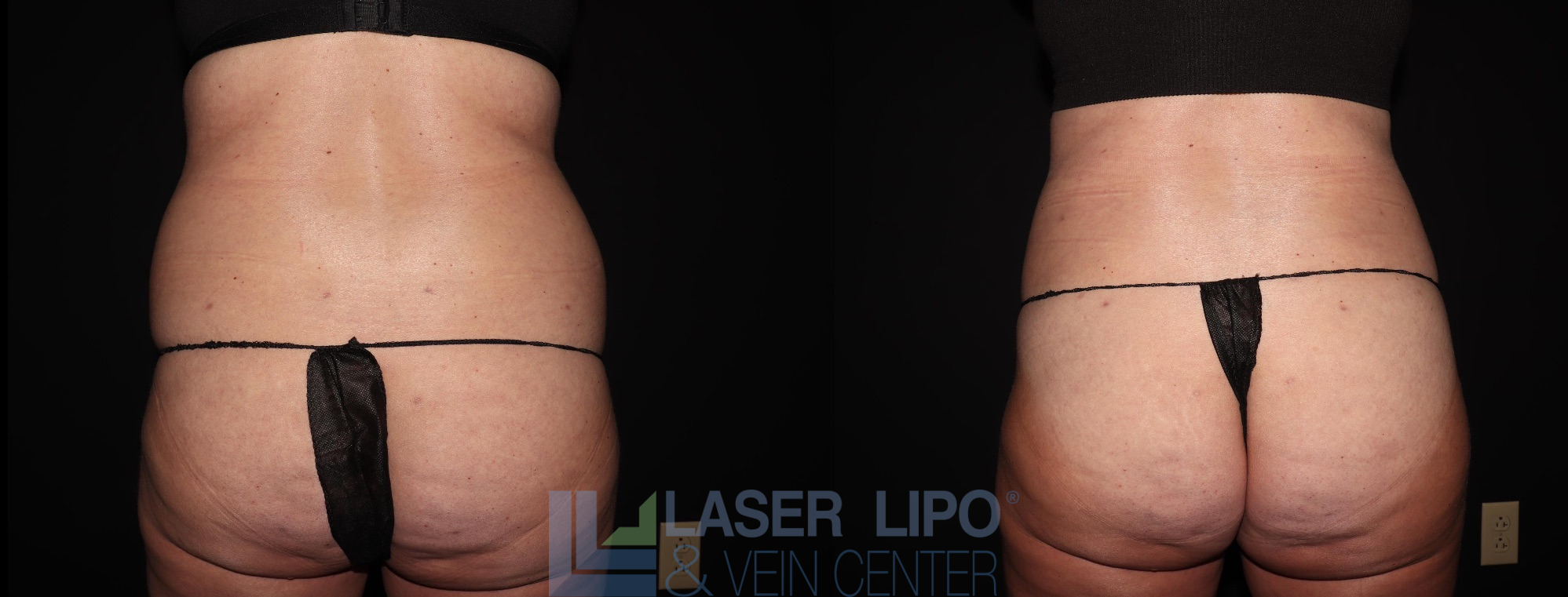 Before and After Image: Liposuction – Back-Bra Line - back