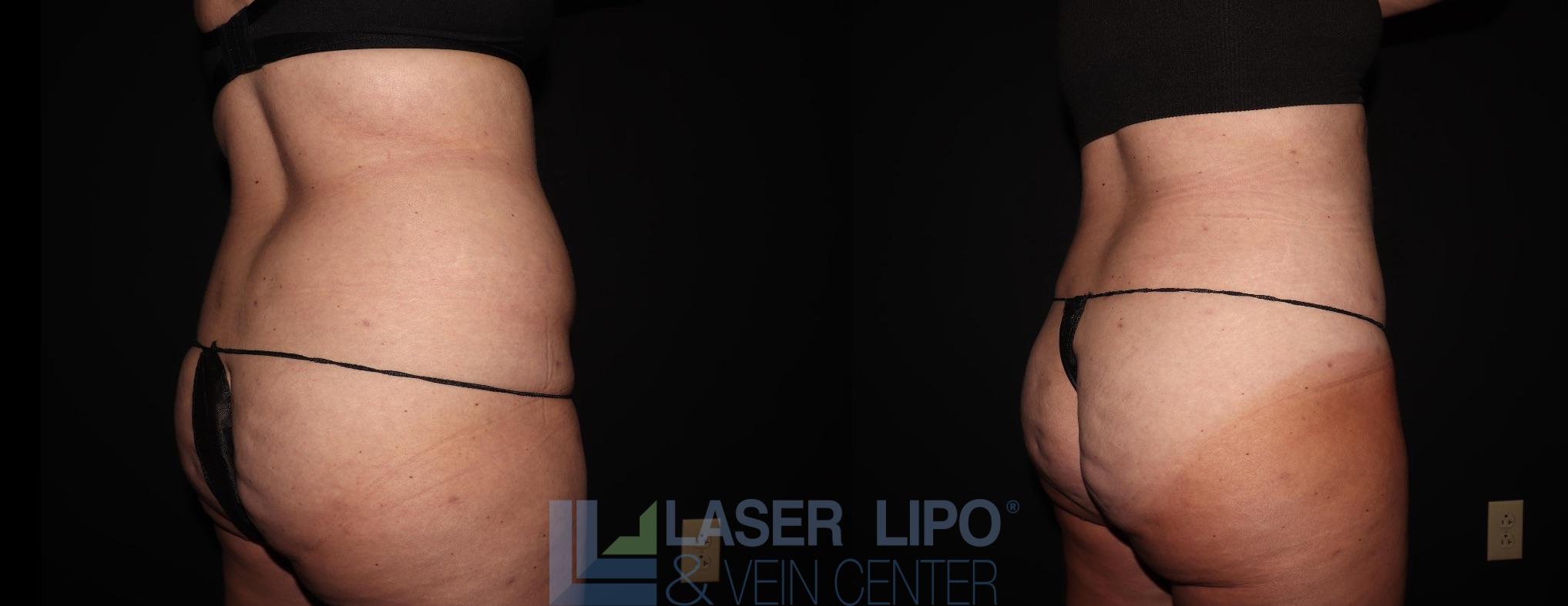 Before and After Image: Liposuction – Back-Bra Line - right-back-oblique
