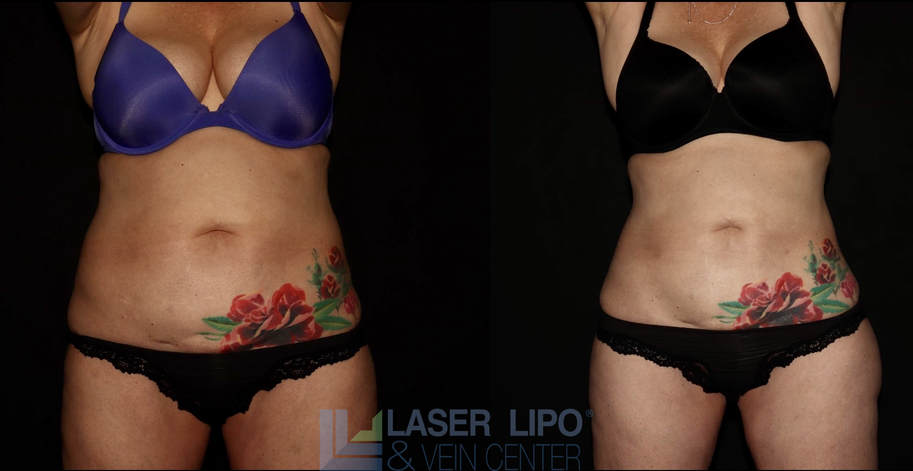 Before and After Image: Lipedema – Abdomen/Flanks - front
