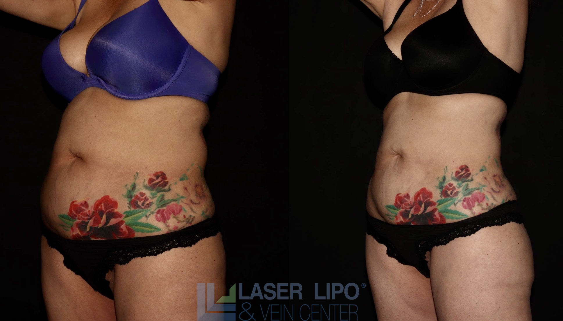 Before and After Image: Lipedema – Abdomen/Flanks - left-front-oblique