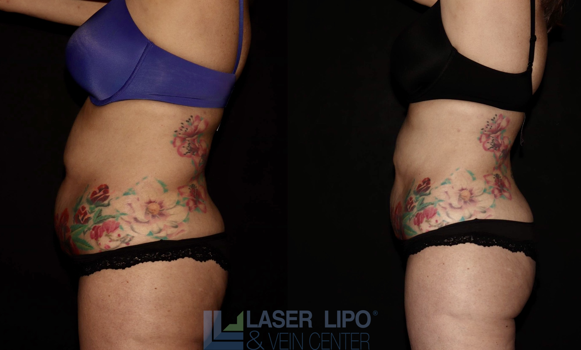 Before and After Image: Lipedema – Abdomen/Flanks - left-side