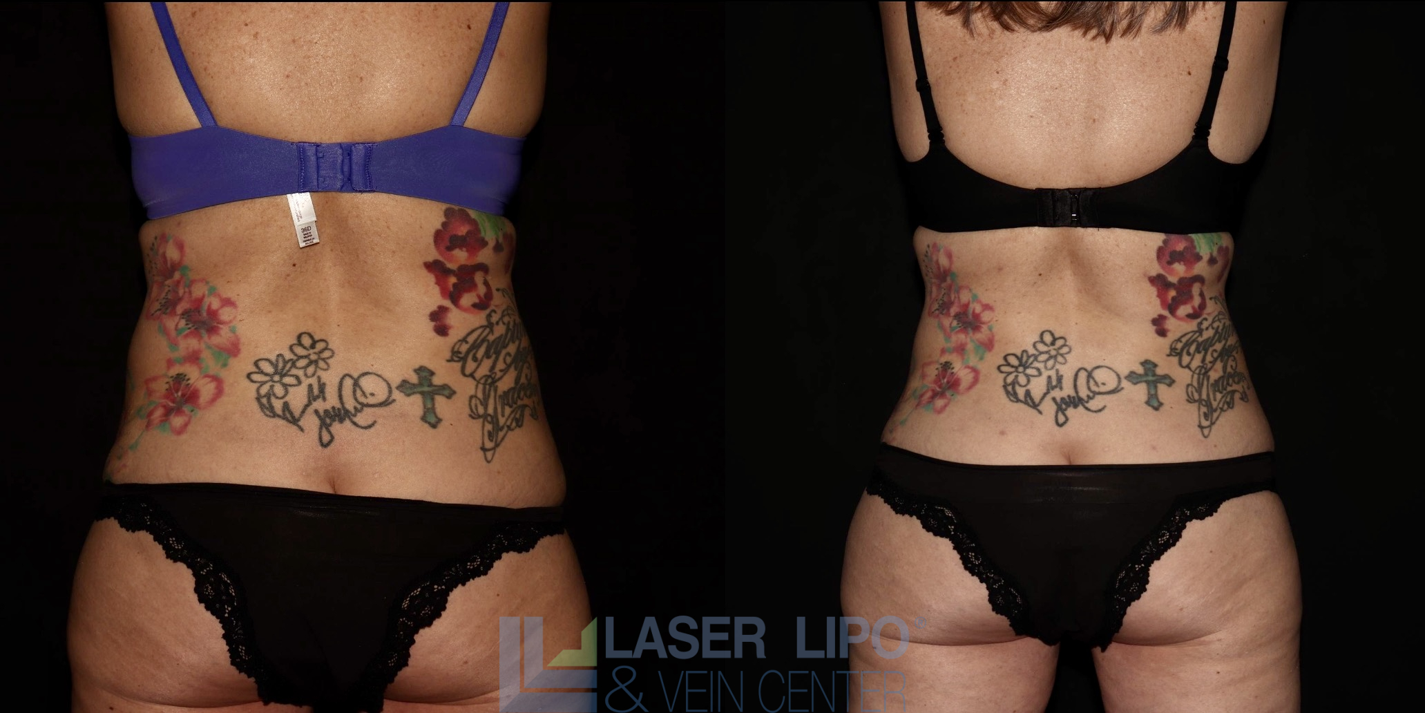 Before and After Image: Lipedema – Abdomen/Flanks - back