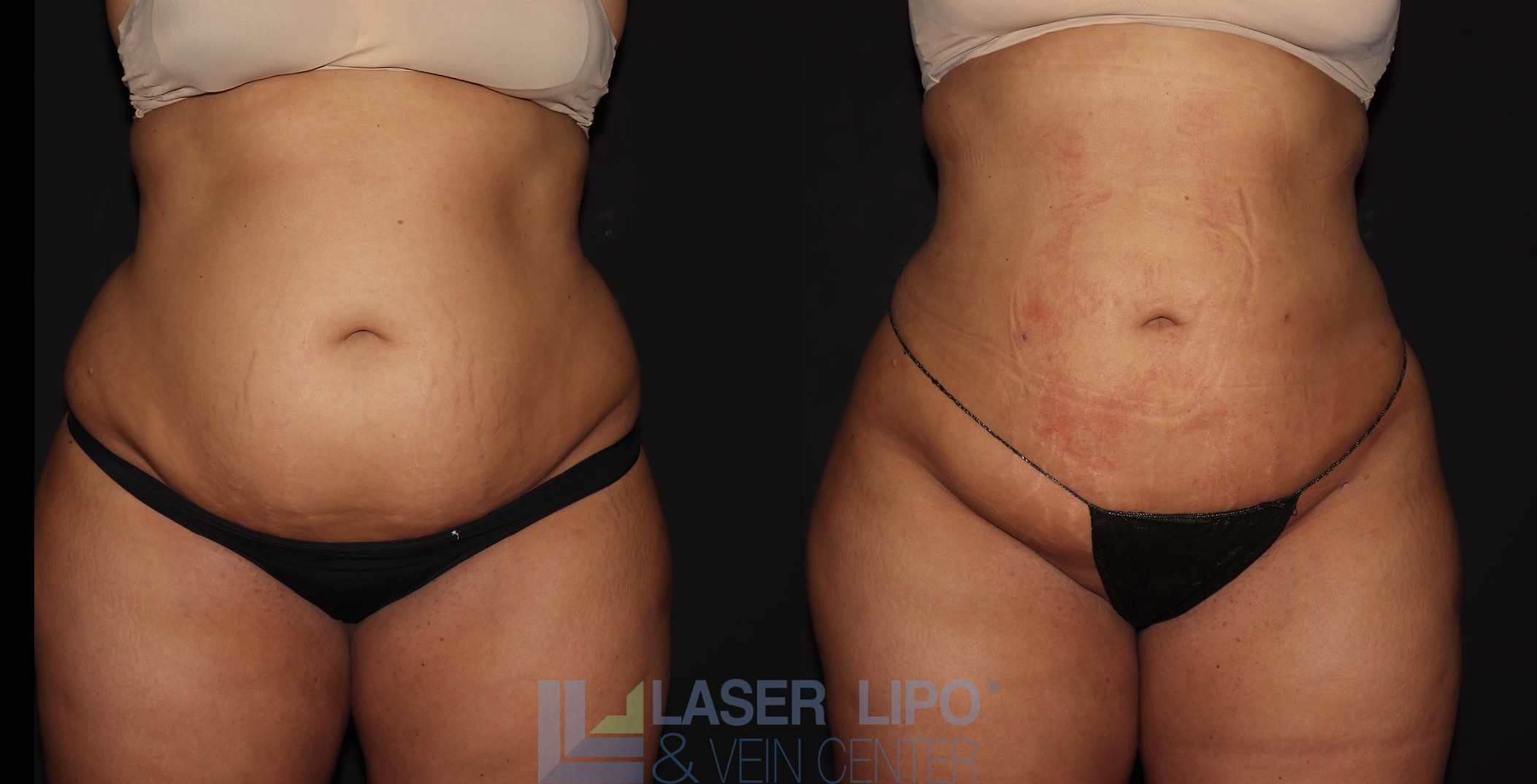 Before and After Image: Lipedema – Abdomen/Flanks - front