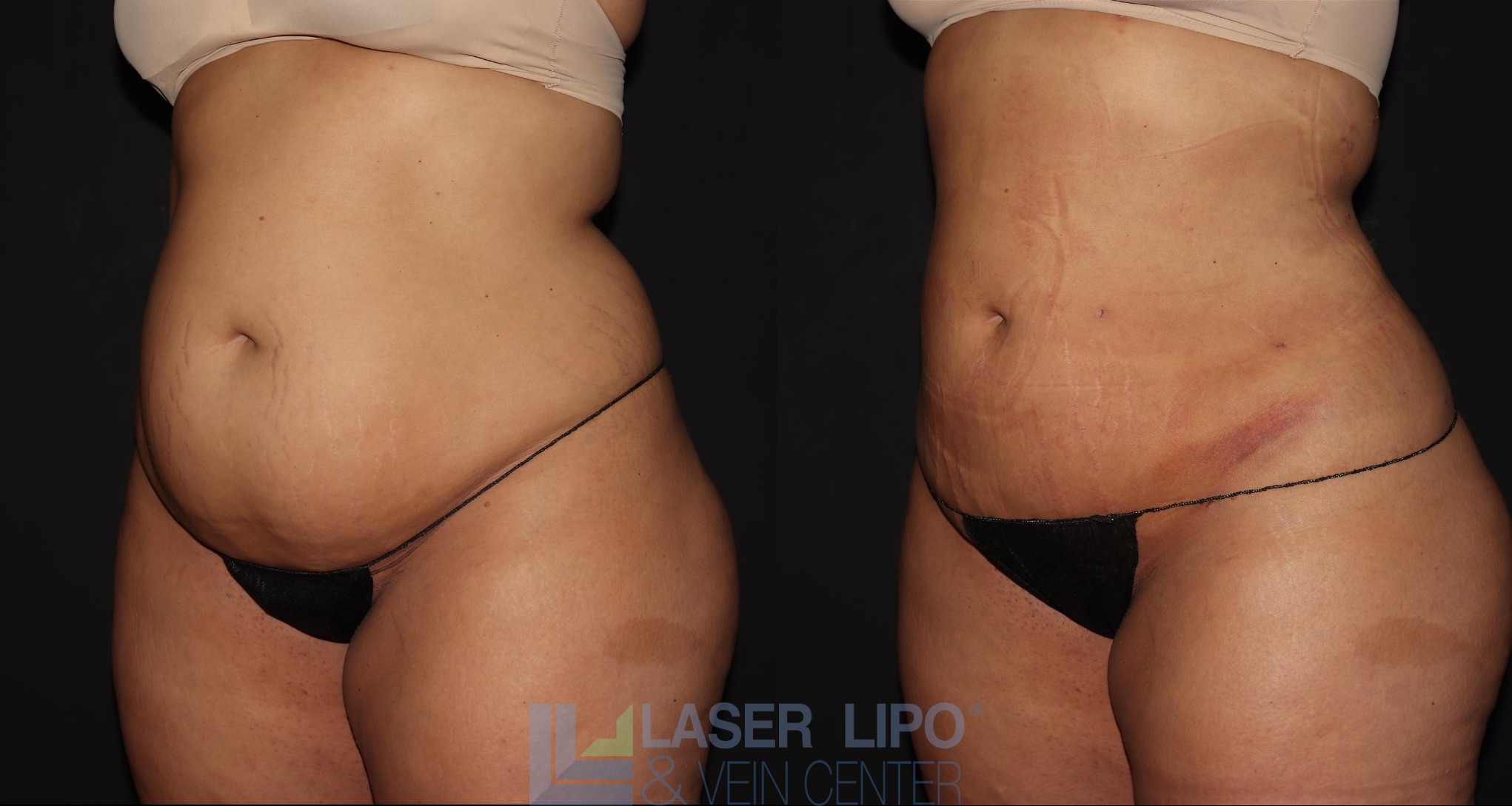Before and After Image: Lipedema – Abdomen/Flanks - left-front-oblique