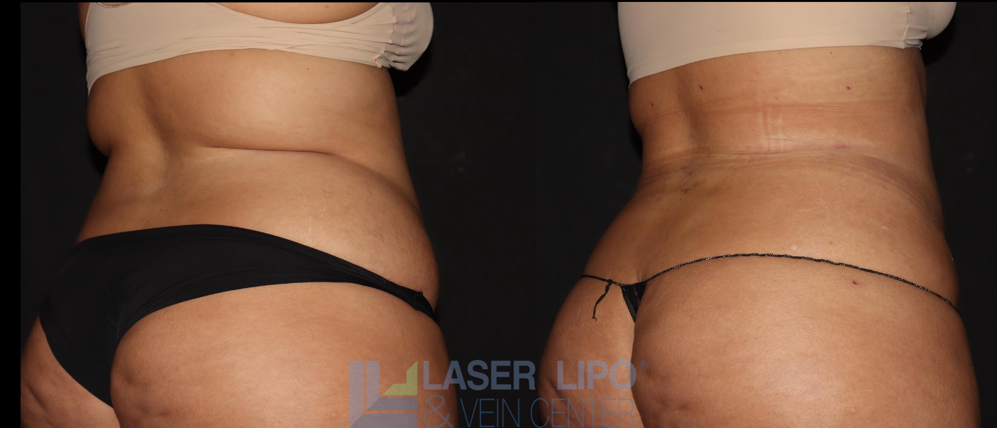 Before and After Image: Lipedema – Abdomen/Flanks - right-back-oblique
