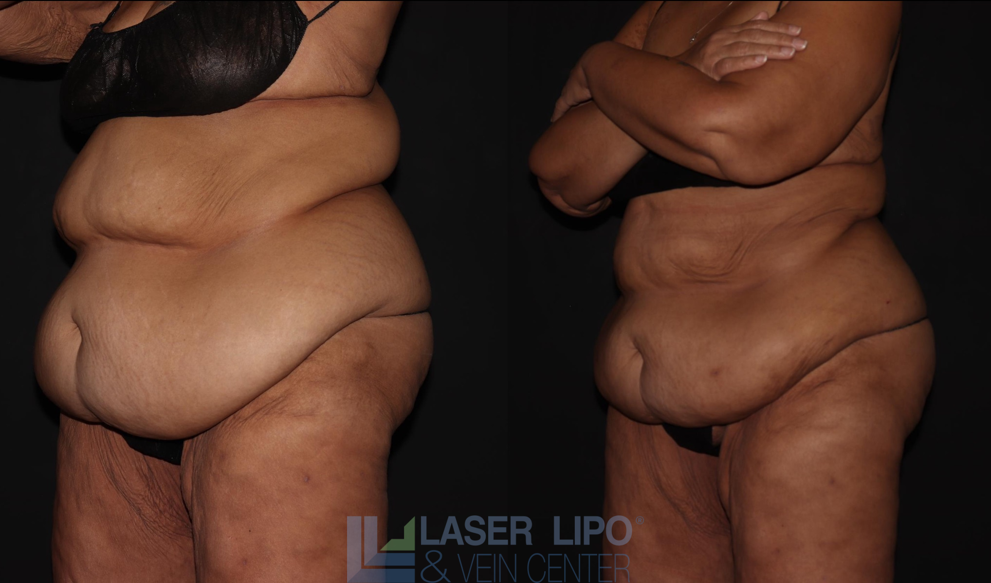 Before and After Image: Lipedema – Abdomen/Flanks - left-front-oblique