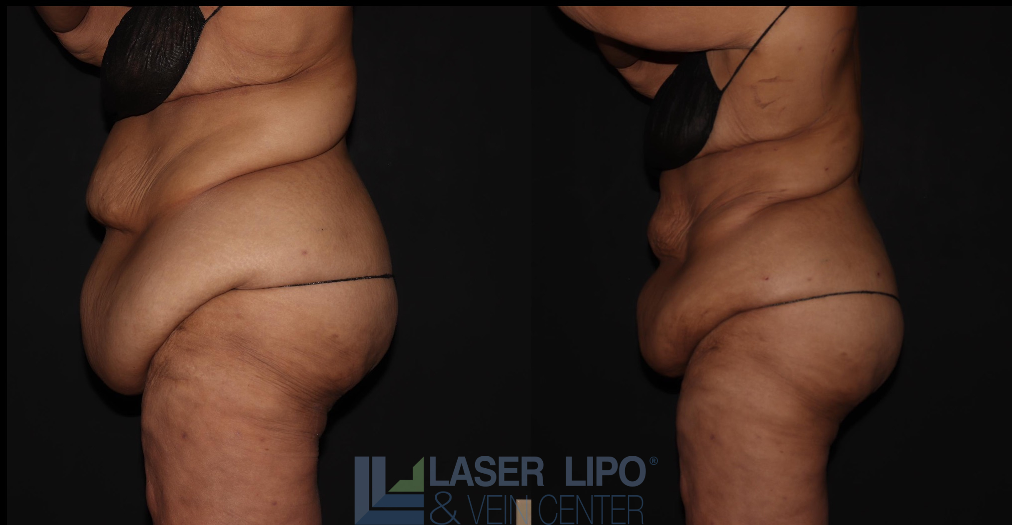 Before and After Image: Lipedema – Abdomen/Flanks - left-side