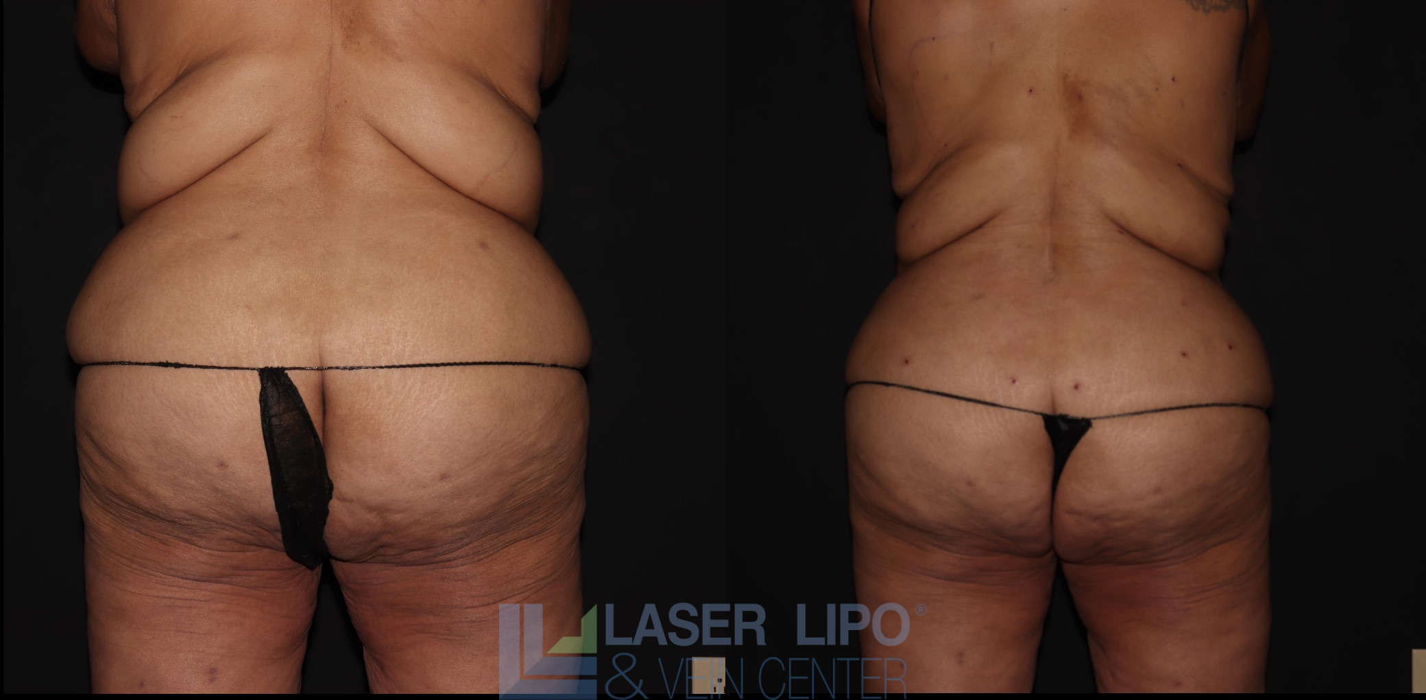 Before and After Image: Lipedema – Abdomen/Flanks - back
