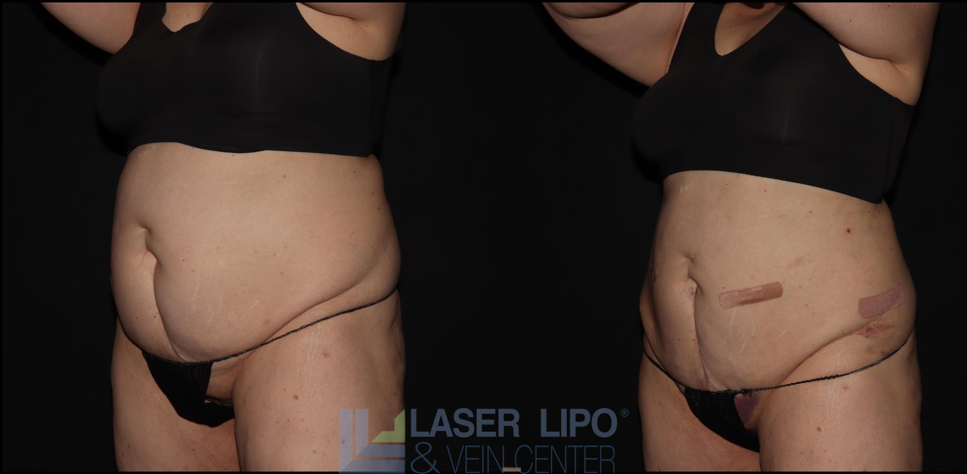 Before and After Image: Lipedema – Abdomen/Flanks - left-front-oblique