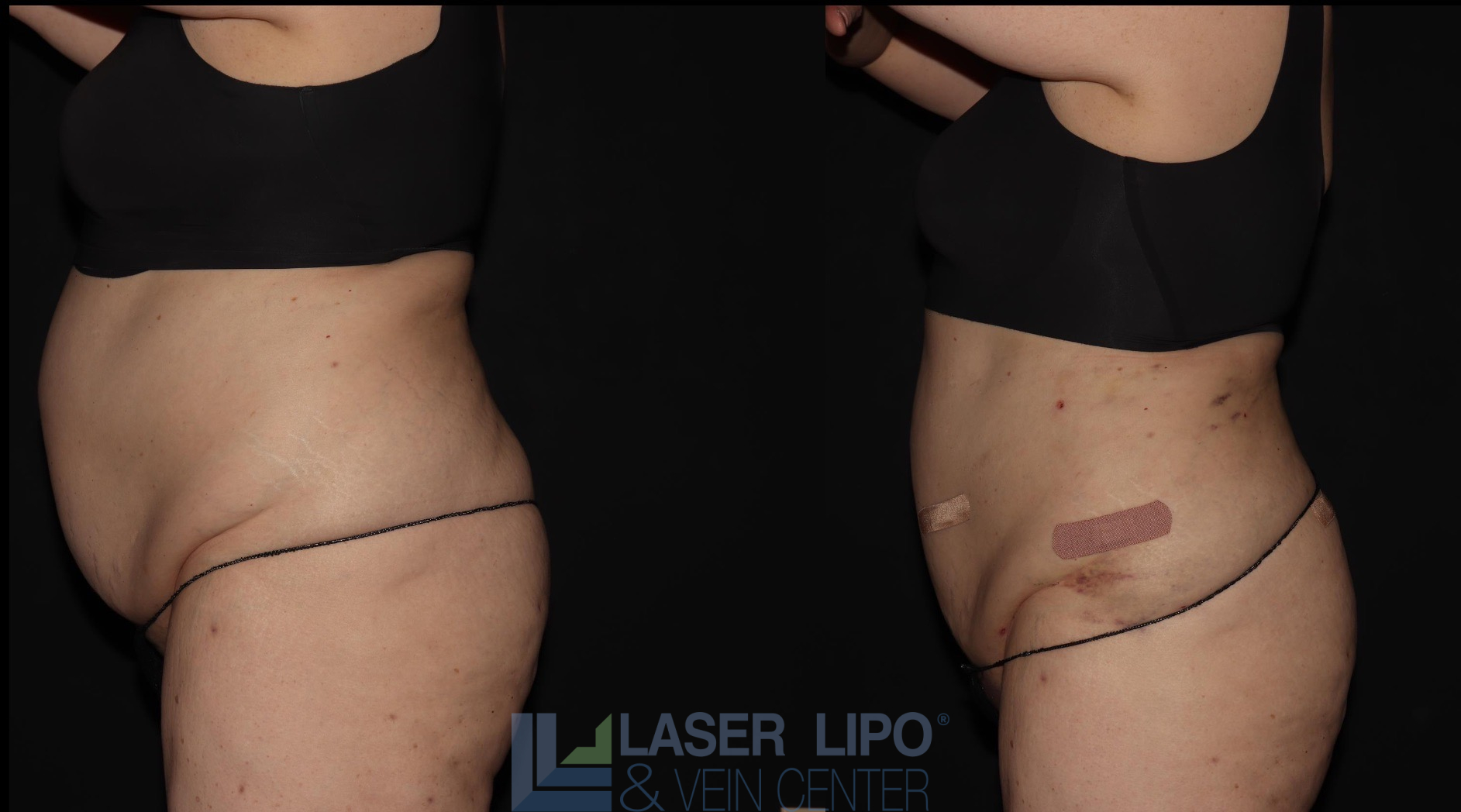 Before and After Image: Lipedema – Abdomen/Flanks - left-side