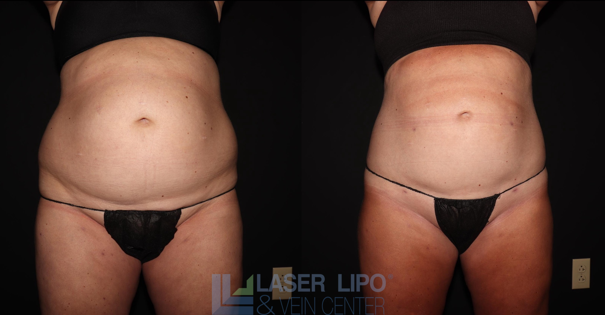 Before and After Image: Lipedema – Abdomen/Flanks - front