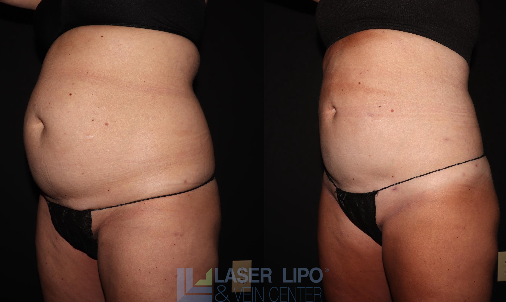Before and After Image: Lipedema – Abdomen/Flanks - left-front-oblique