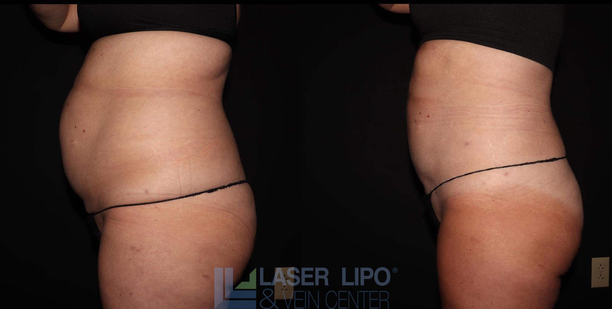 Before and After Image: Lipedema – Abdomen/Flanks - left-side