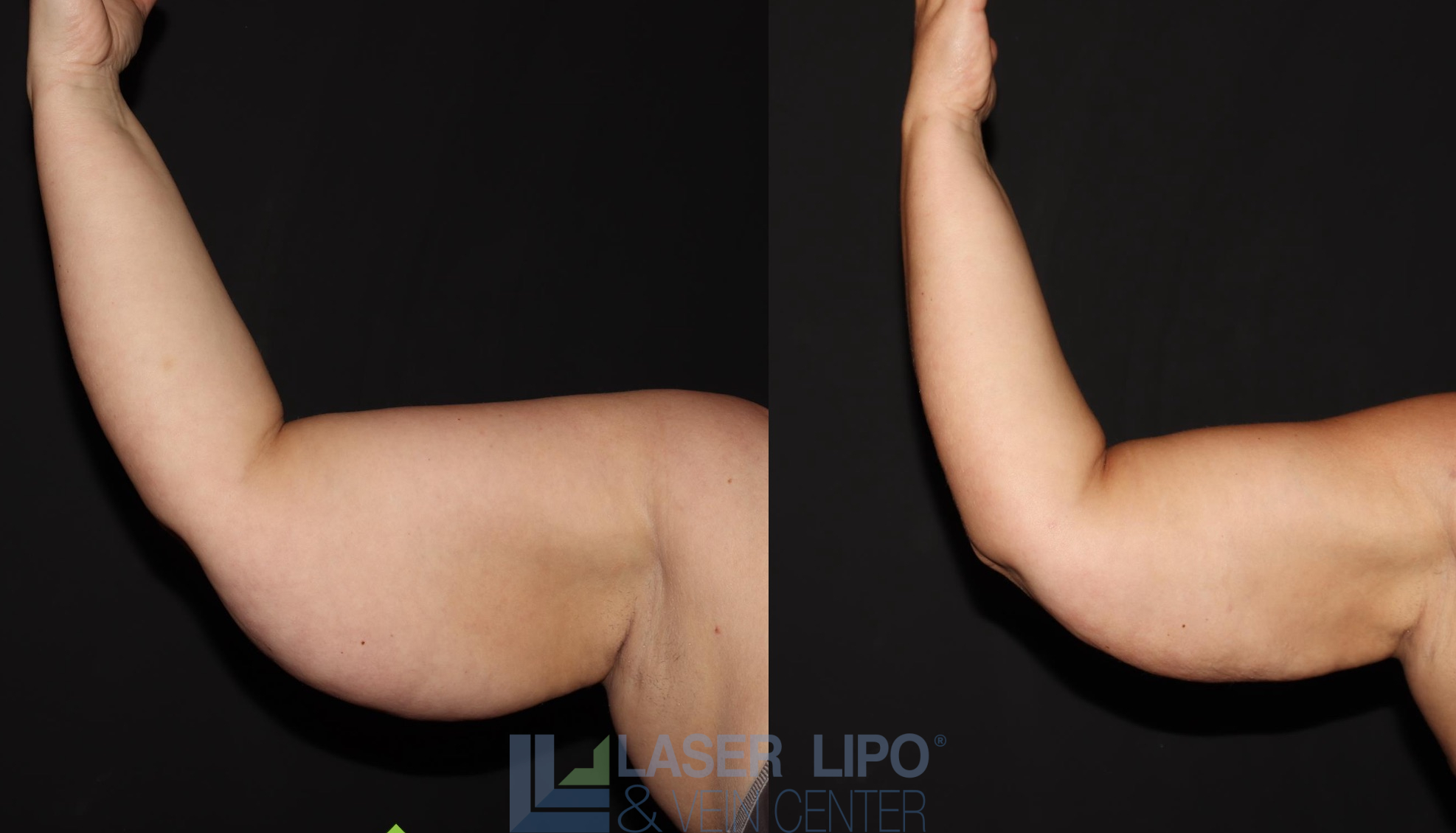 Before and After Image: Lipedema – Arms