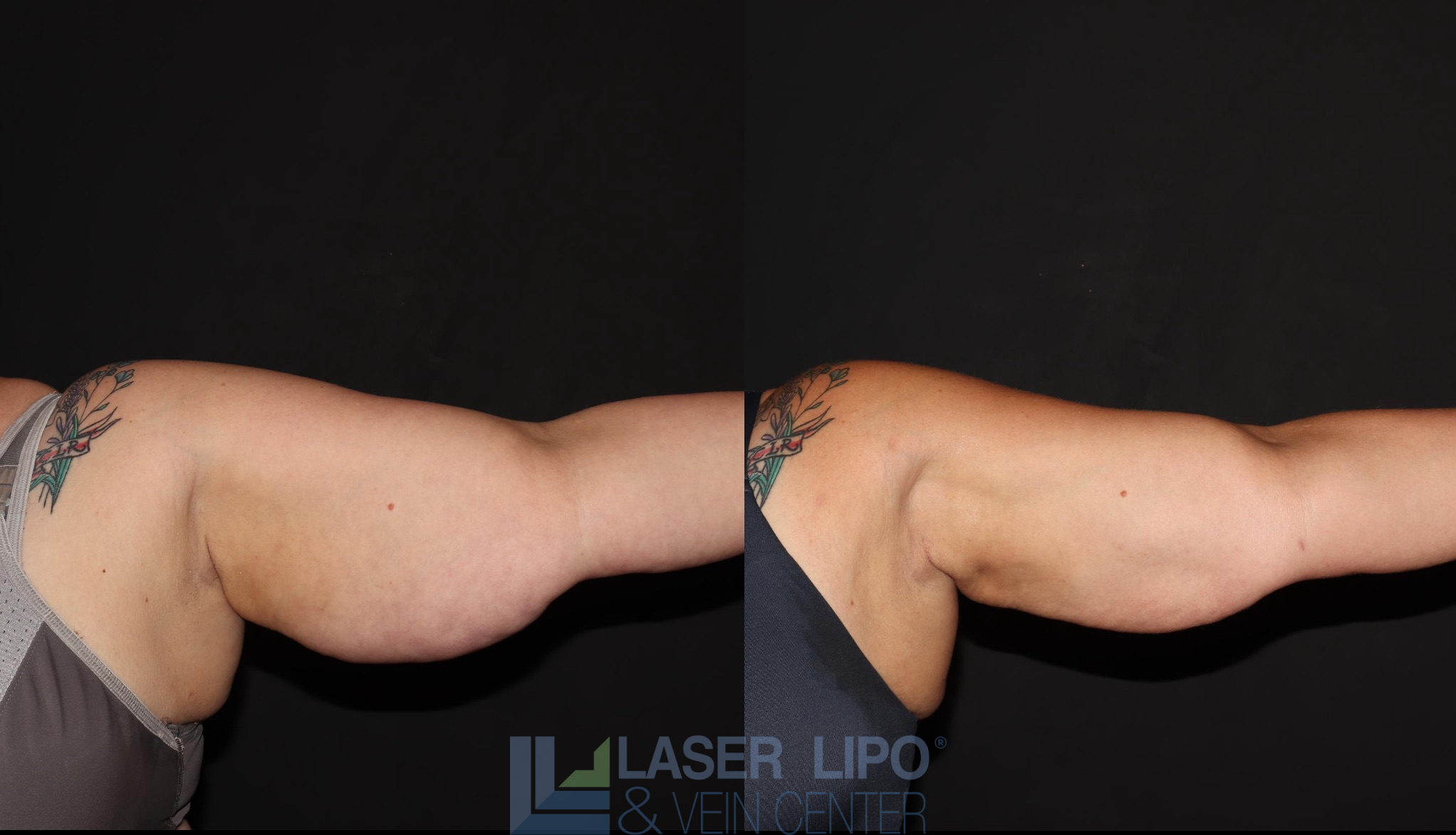 Before and After Image: Lipedema – Arms - front