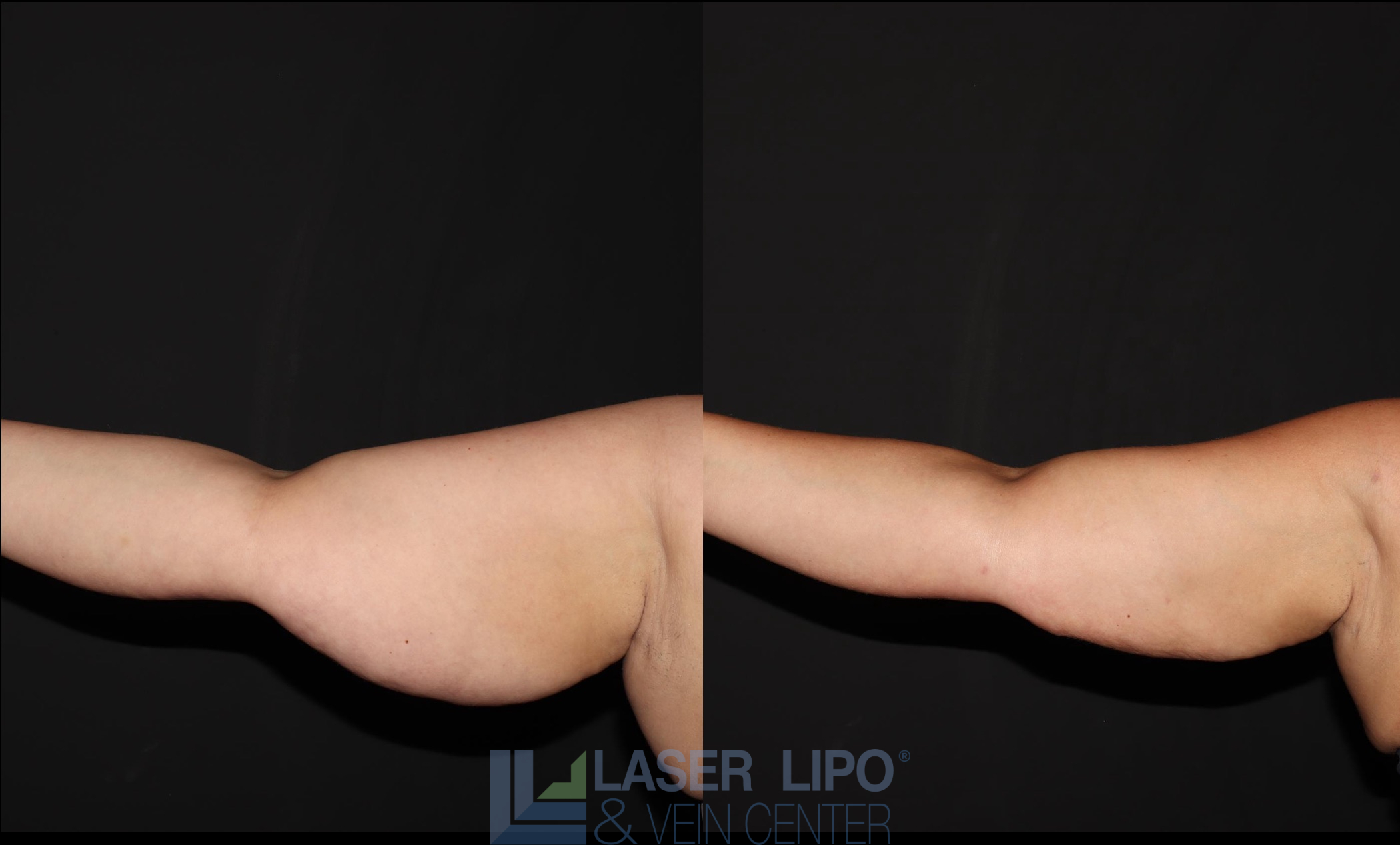 Before and After Image: Lipedema – Arms - front