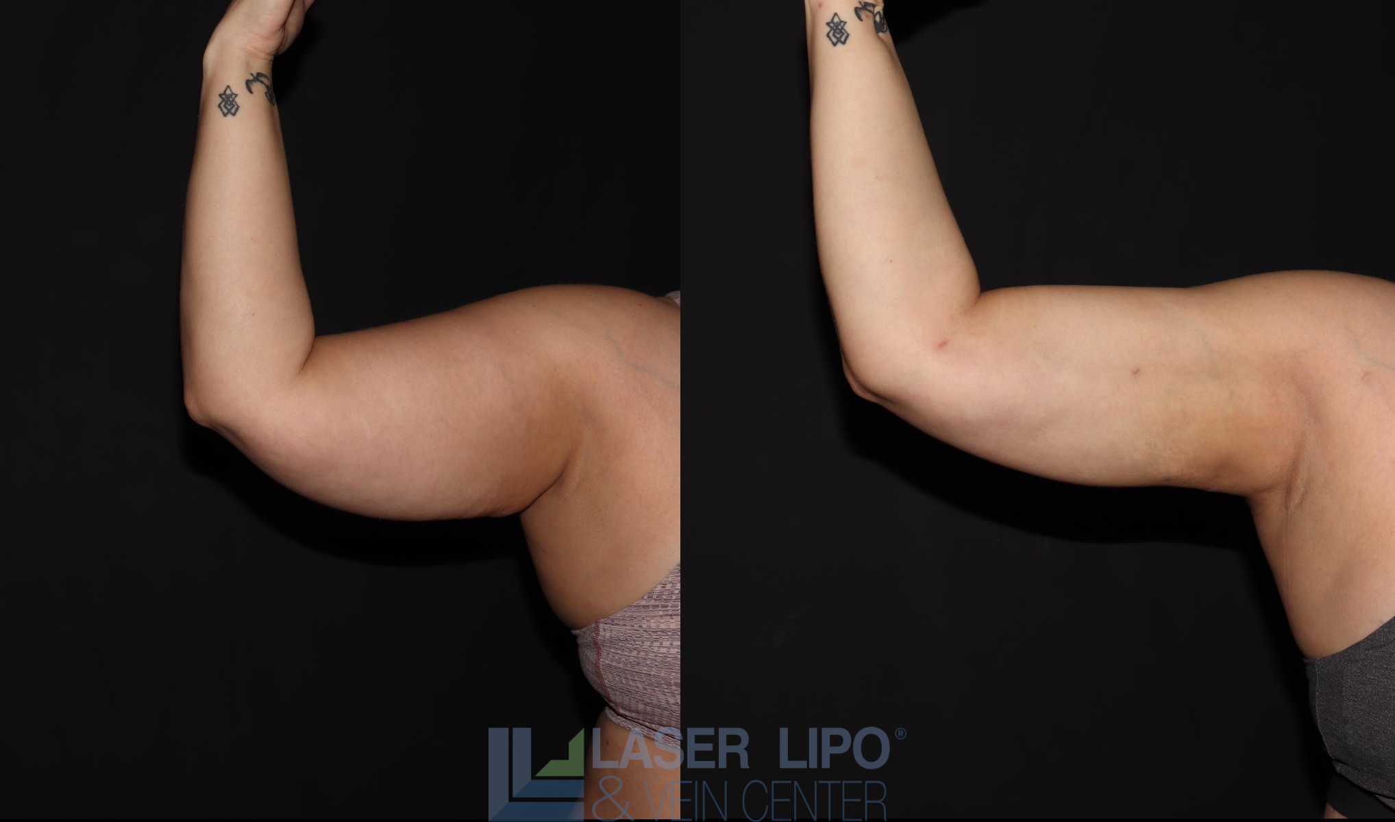 Before and After Image: Lipedema – Arms