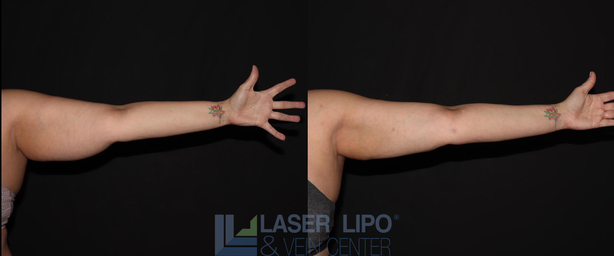 Before and After Image: Lipedema – Arms - front