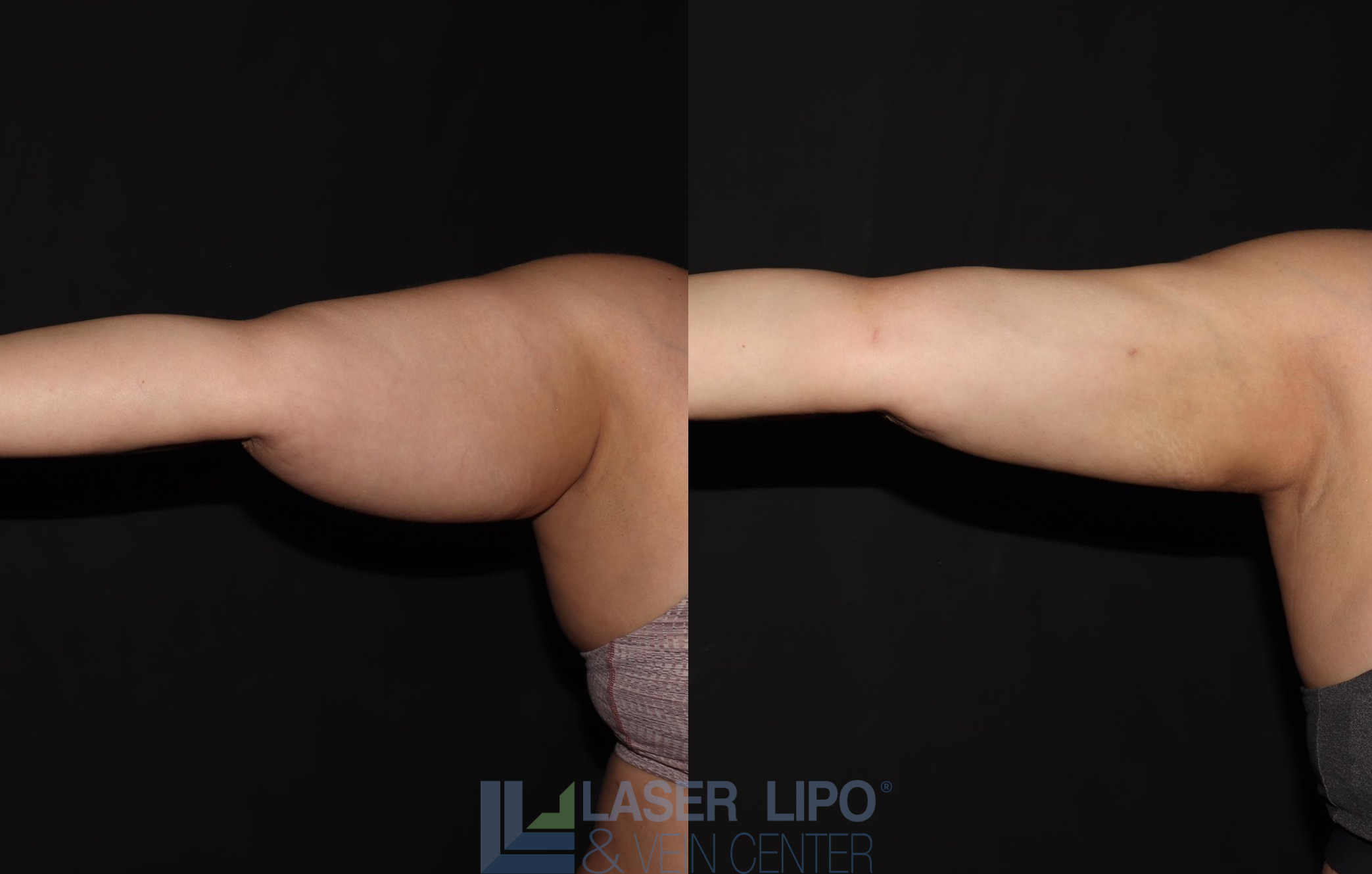 Before and After Image: Lipedema – Arms - front