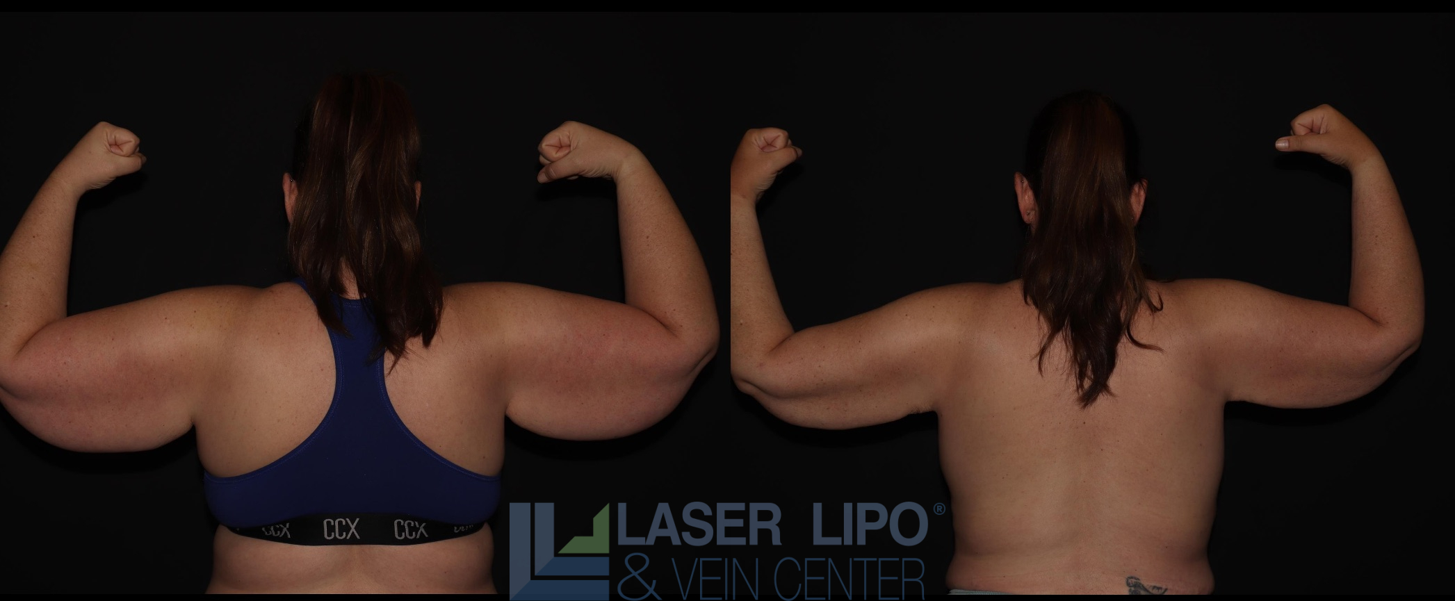 Before and After Image: Lipedema – Arms