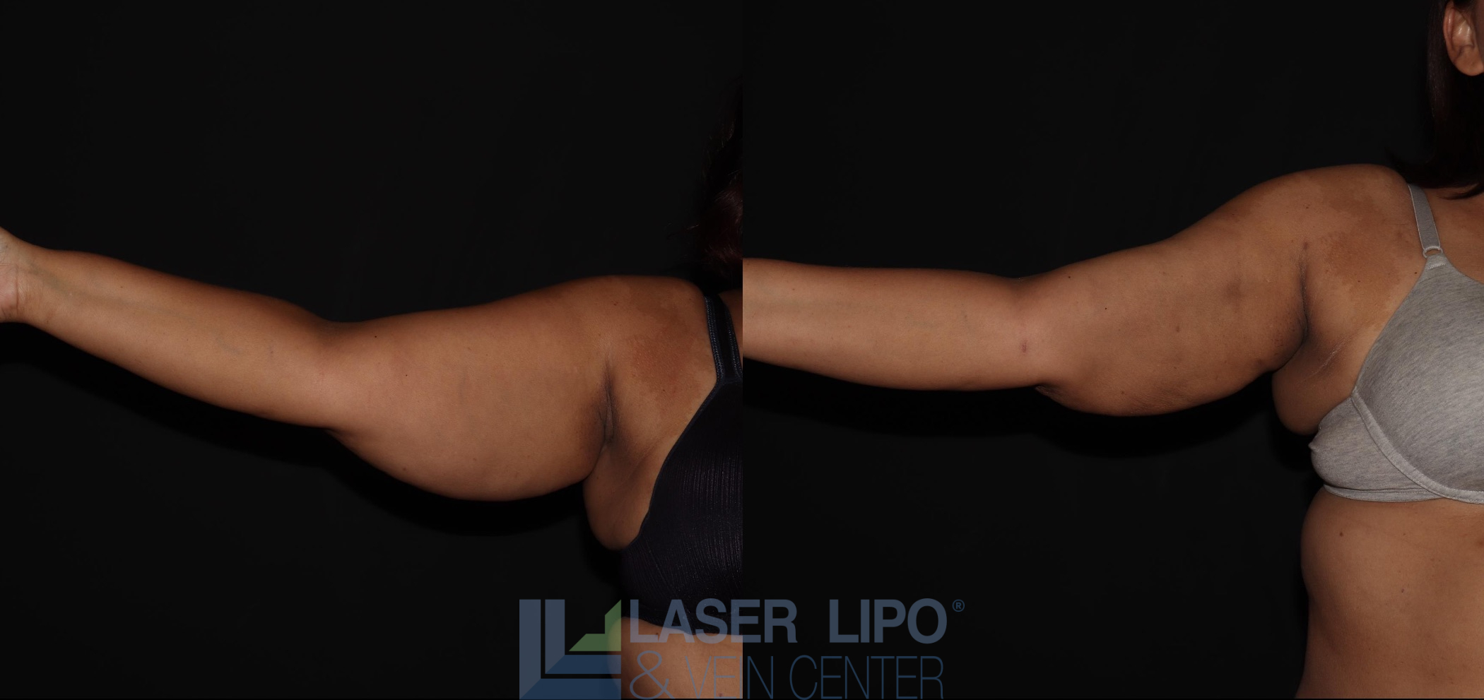 Before and After Image: Lipedema – Arms