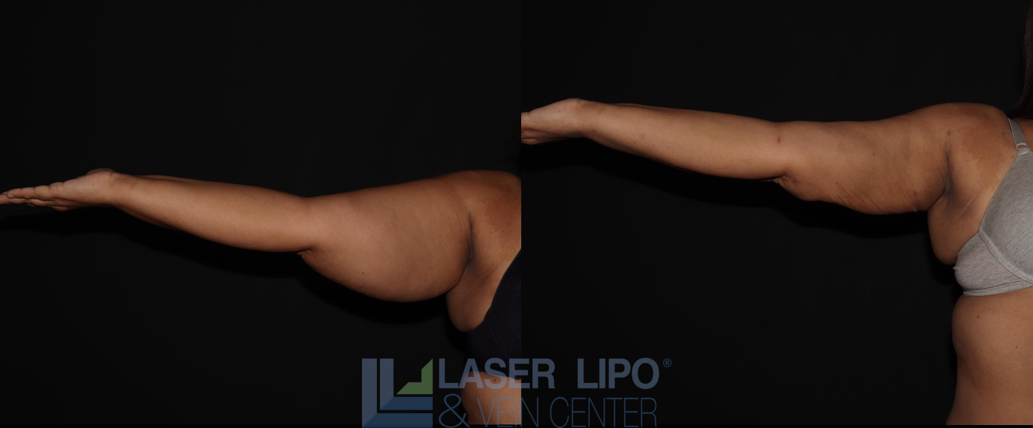 Before and After Image: Lipedema – Arms - front