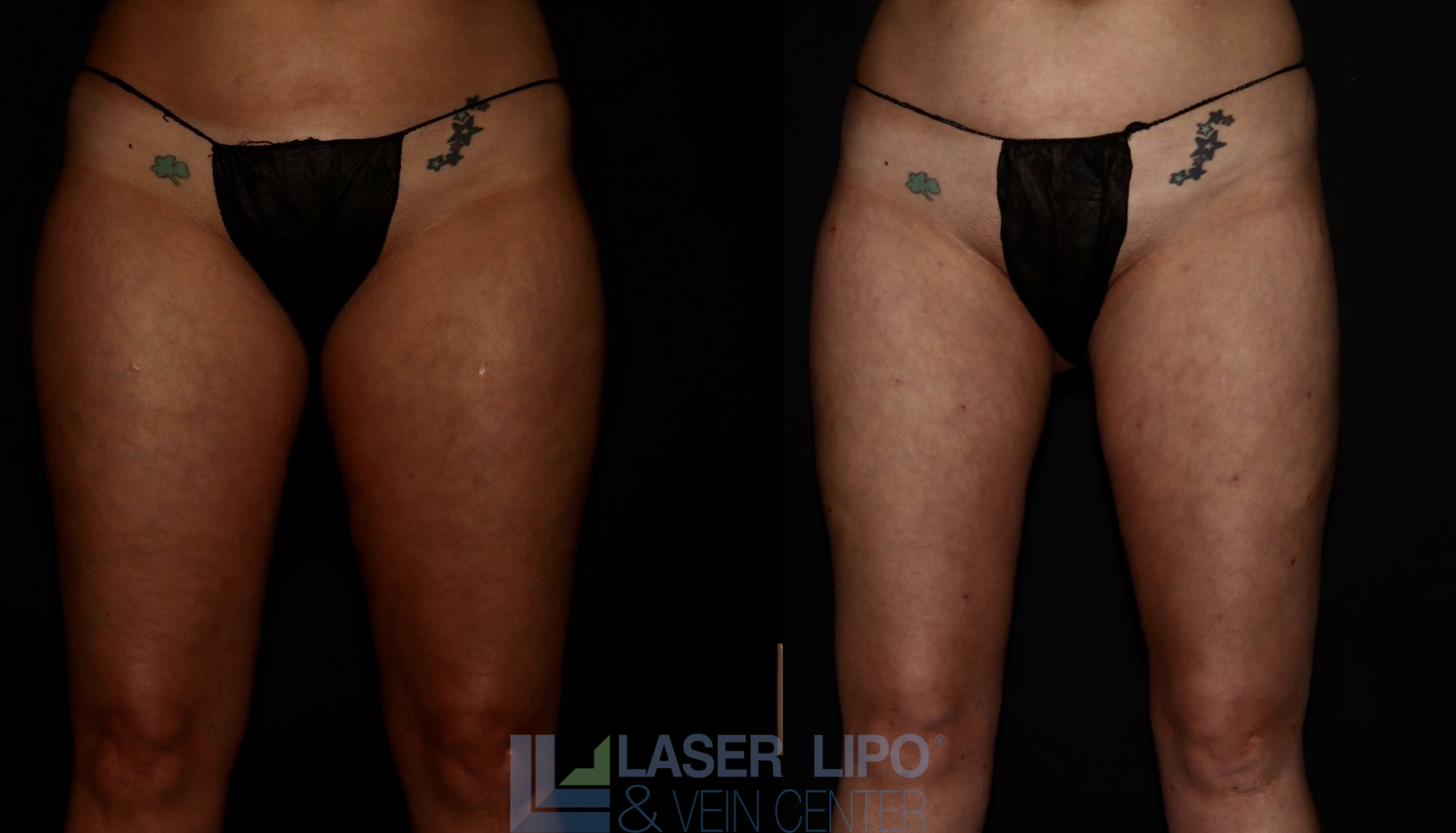 Before and After Image: Lipedema – Thighs