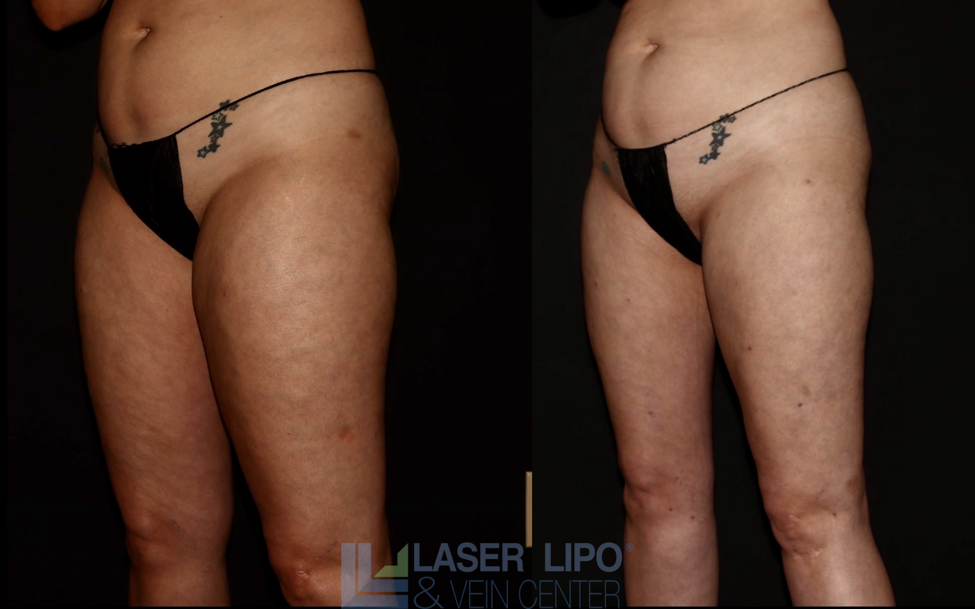 Before and After Image: Lipedema – Thighs - left-front-oblique