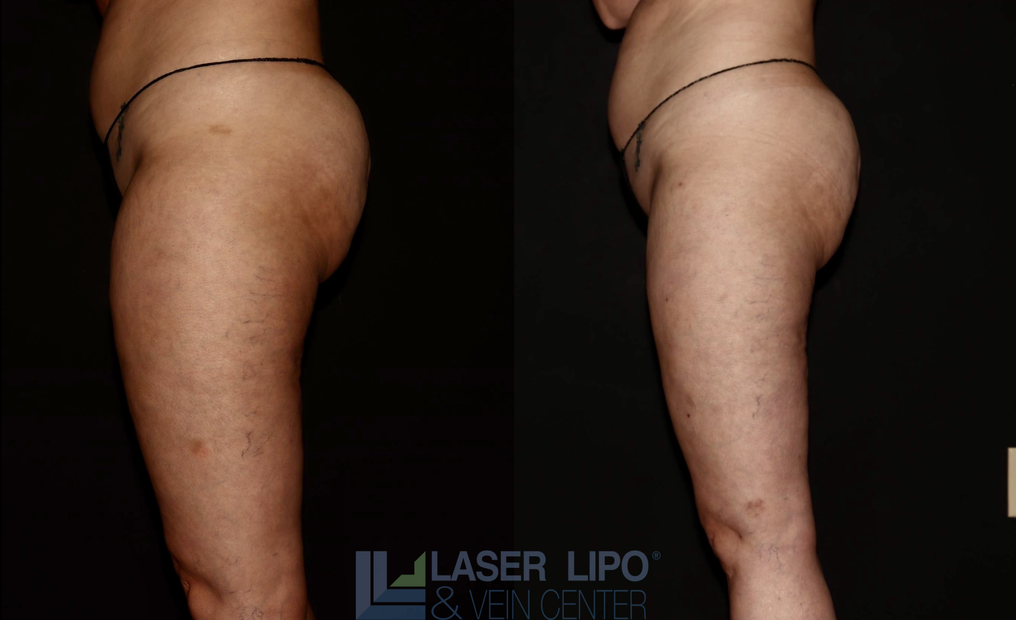 Before and After Image: Lipedema – Thighs - left-side