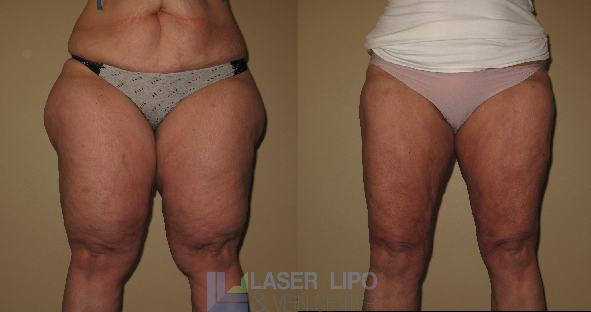 Before and After Image: Lipedema – Thighs