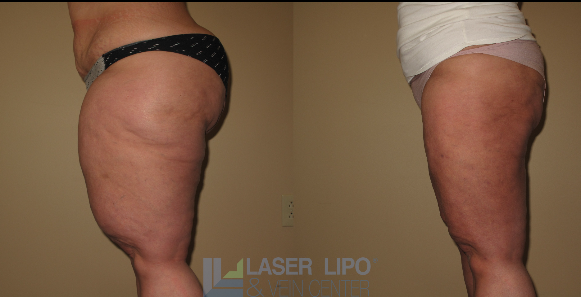 Before and After Image: Lipedema – Thighs - left-side
