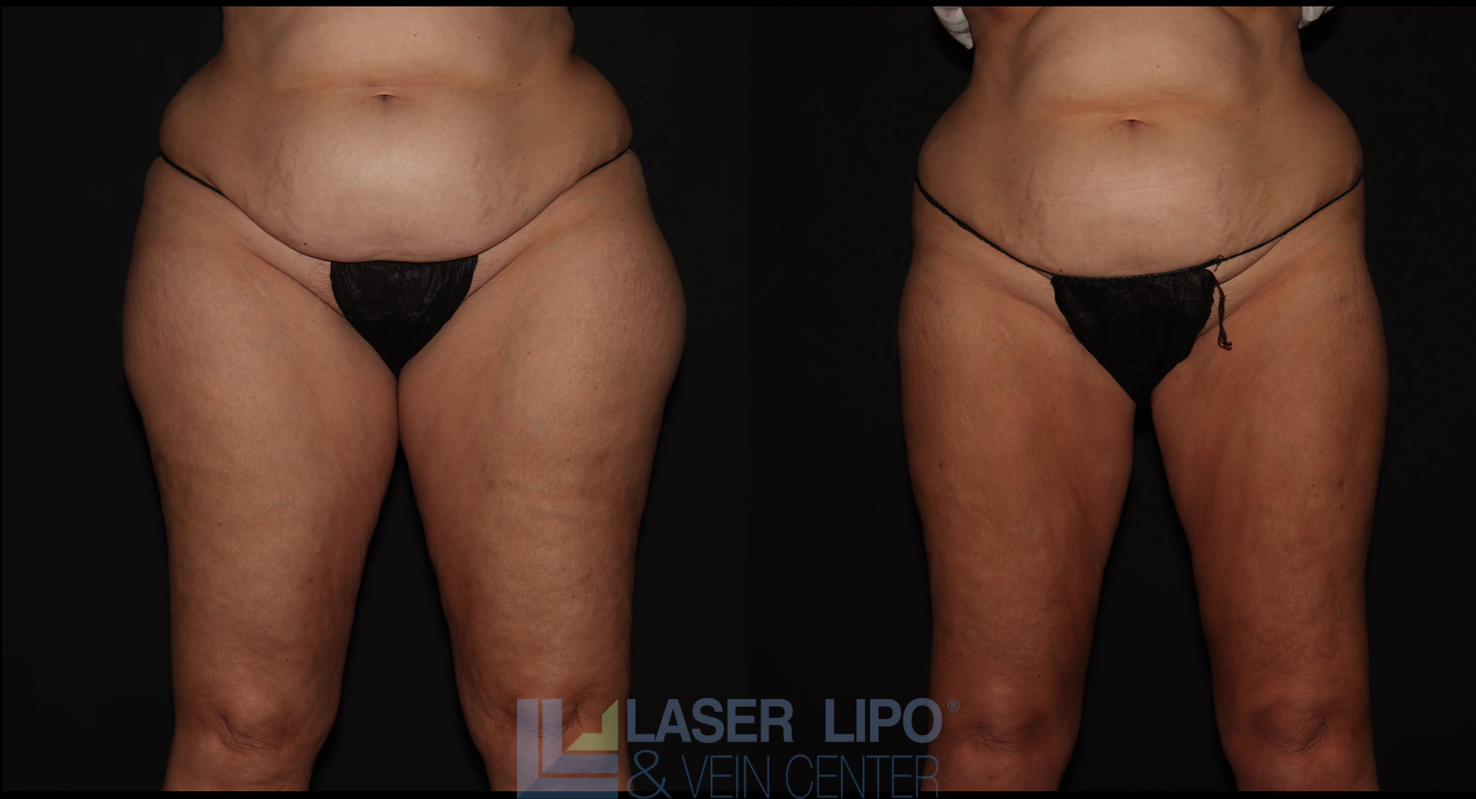 Before and After Image: Lipedema – Thighs