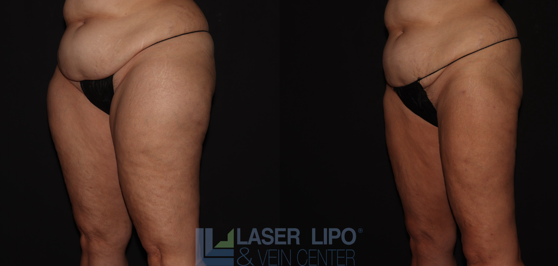 Before and After Image: Lipedema – Thighs - left-front-oblique
