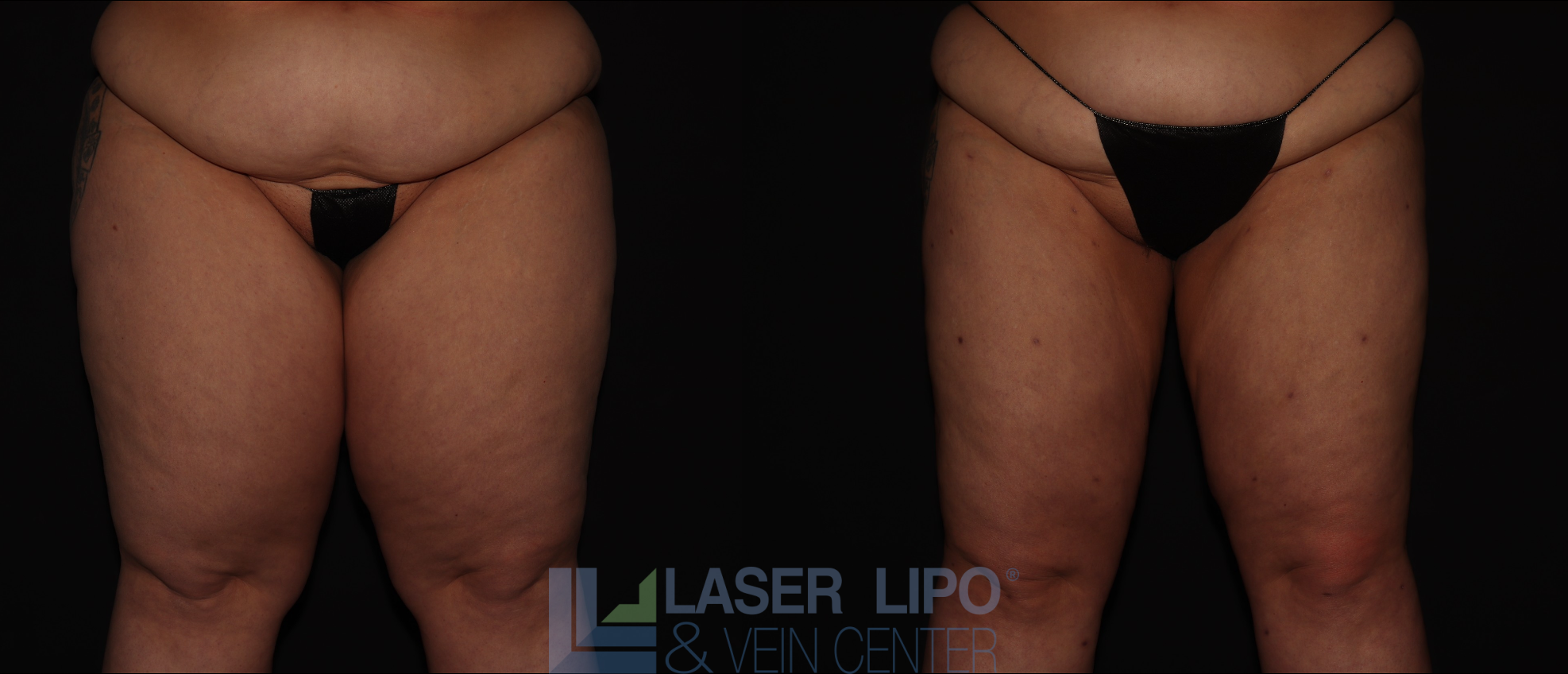 Before and After Image: Lipedema – Thighs - front
