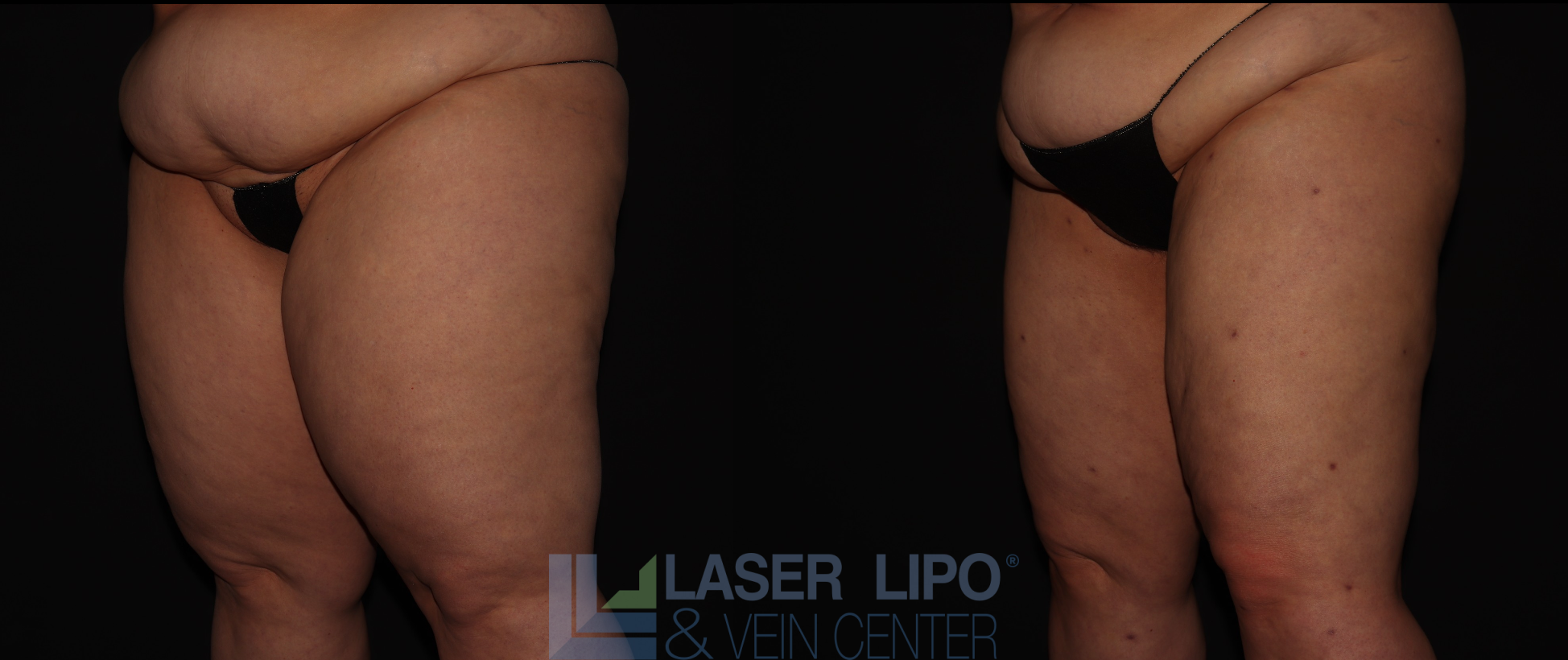 Before and After Image: Lipedema – Thighs - left-front-oblique