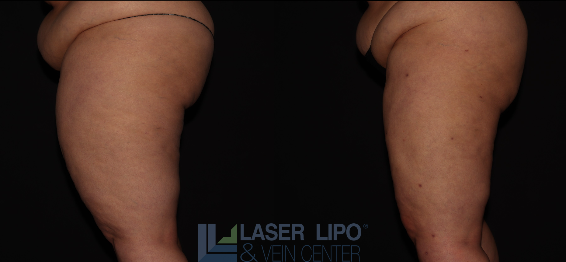 Before and After Image: Lipedema – Thighs - left-side