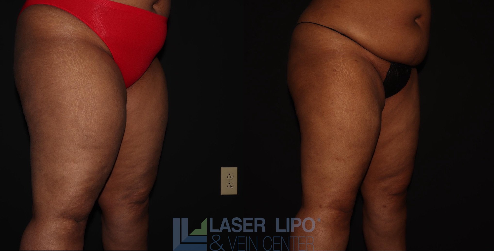 Before and After Image: Lipedema – Thighs - right-front-oblique