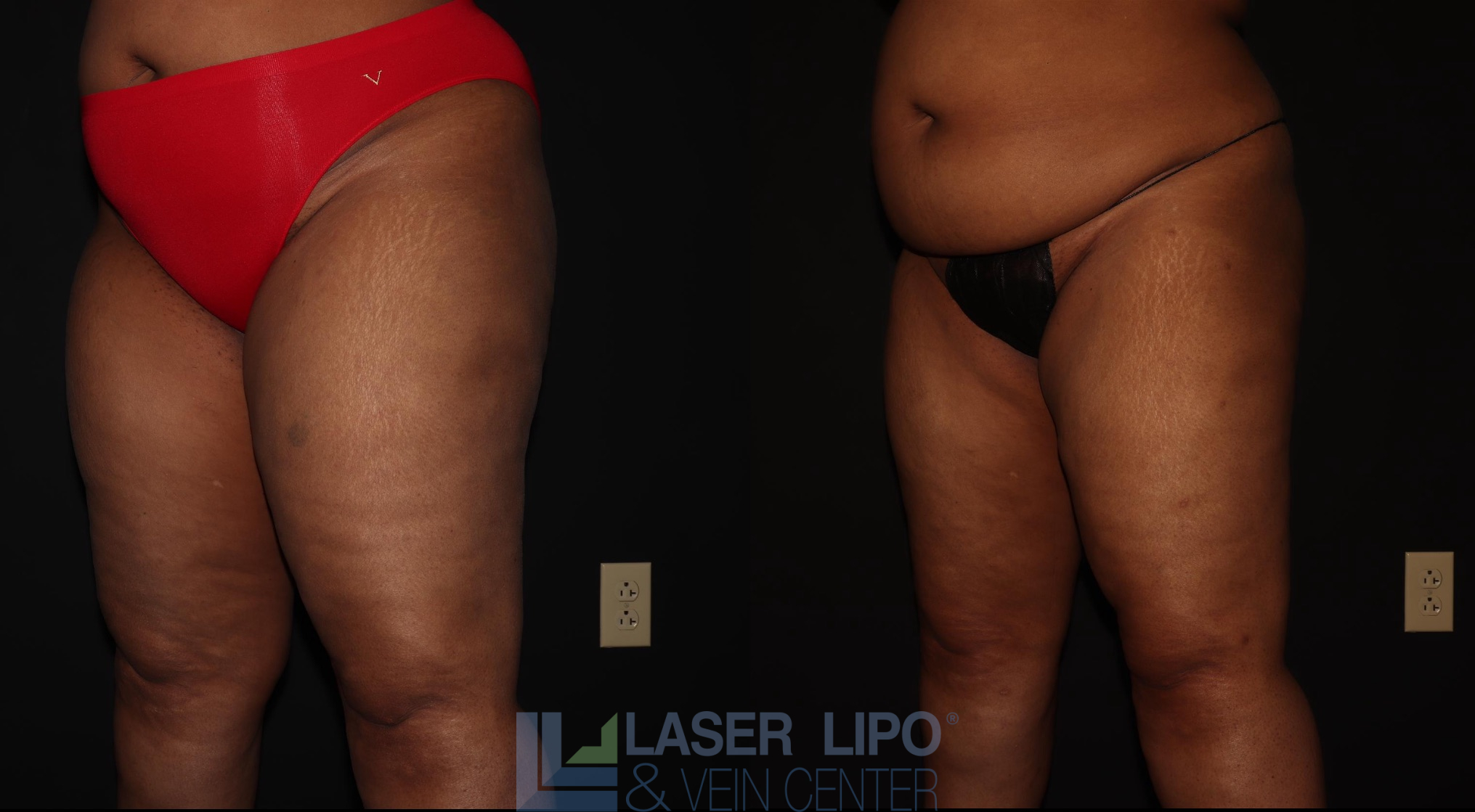 Before and After Image: Lipedema – Thighs - left-front-oblique
