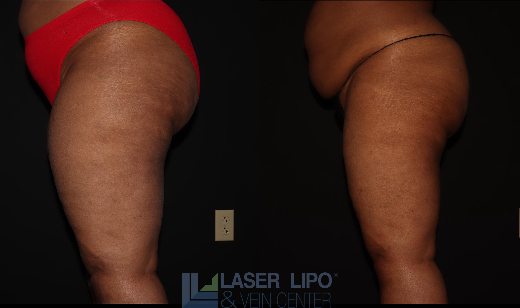 Before and After Image: Lipedema – Thighs - left-side
