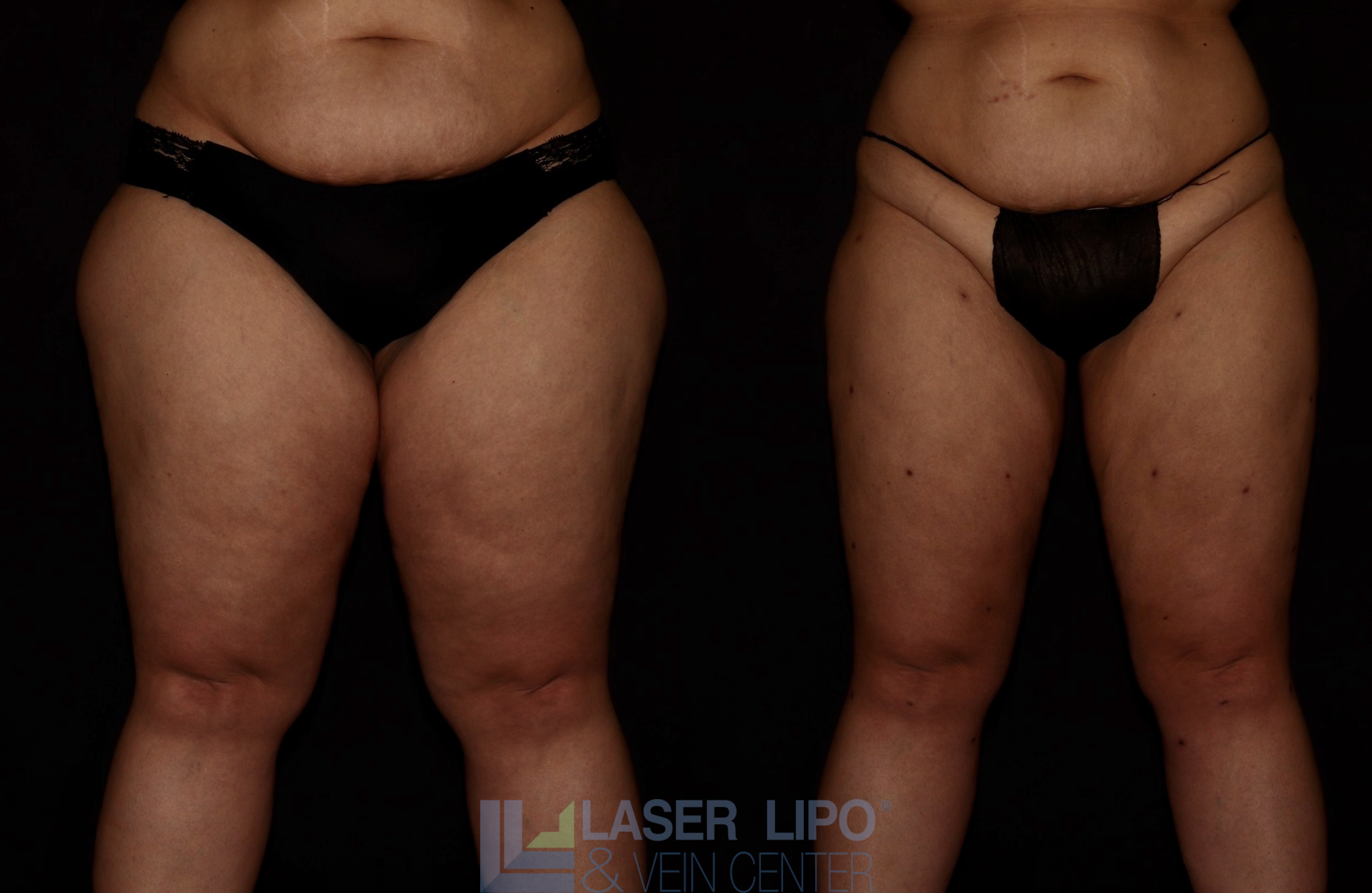 Before and After Image: Lipedema – Thighs - front