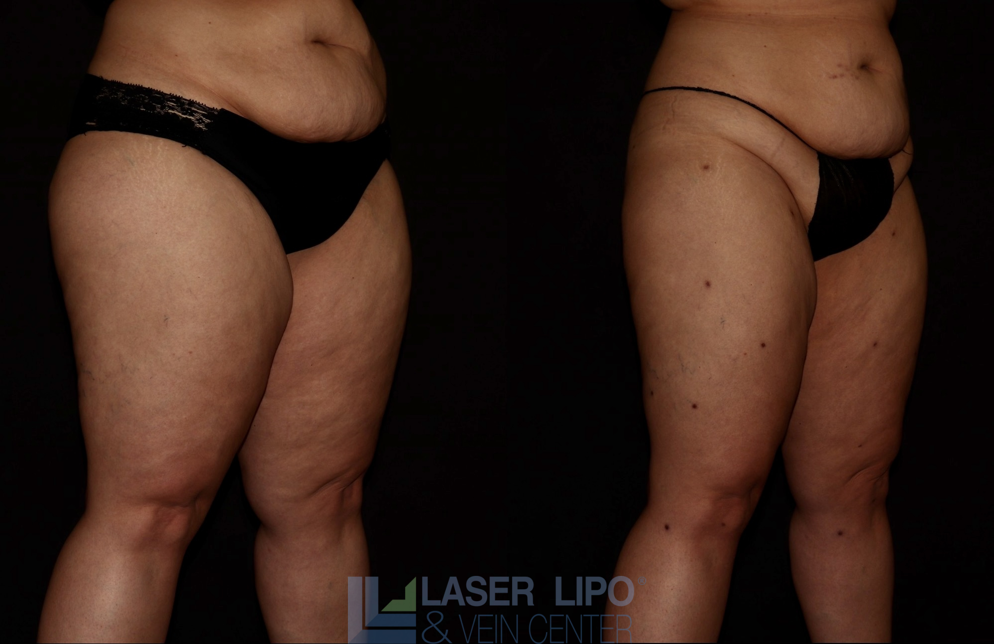 Before and After Image: Lipedema – Thighs - right-front-oblique