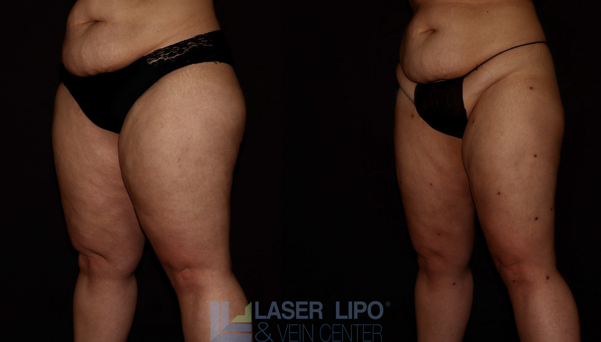 Before and After Image: Lipedema – Thighs - left-front-oblique