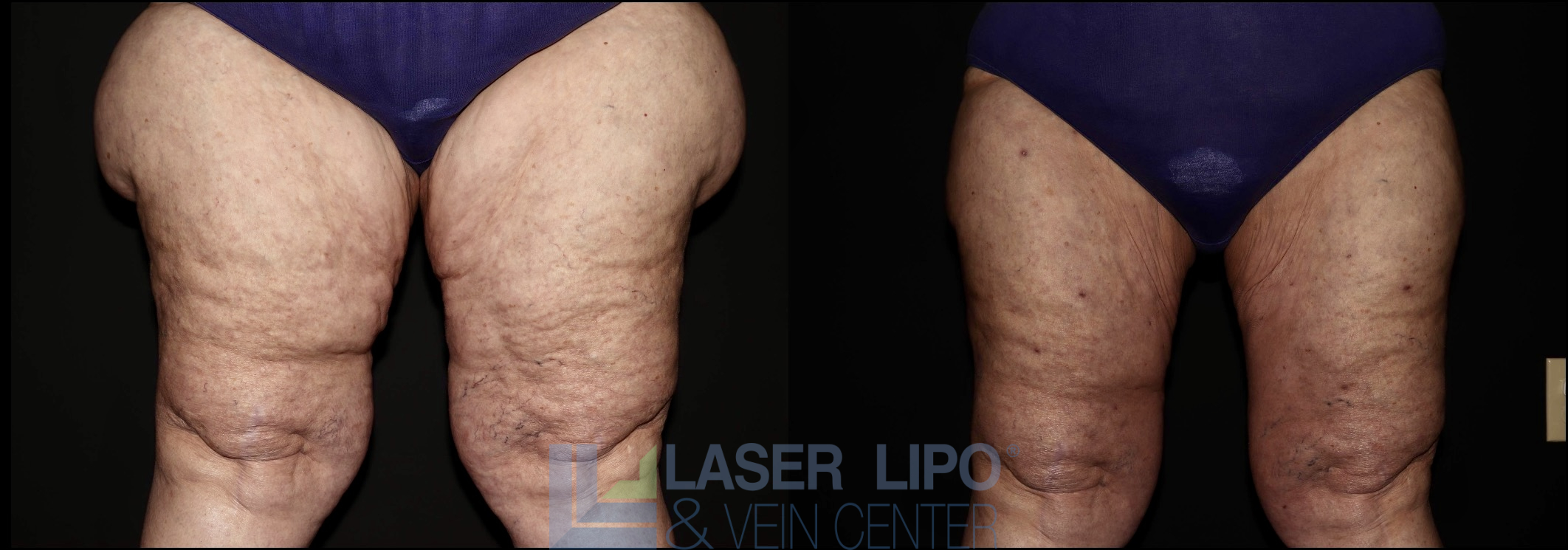 Before and After Image: Lipedema – Thighs - front